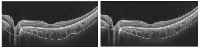Choroidal OCT image enhancement method and device based on signal reverse compensation