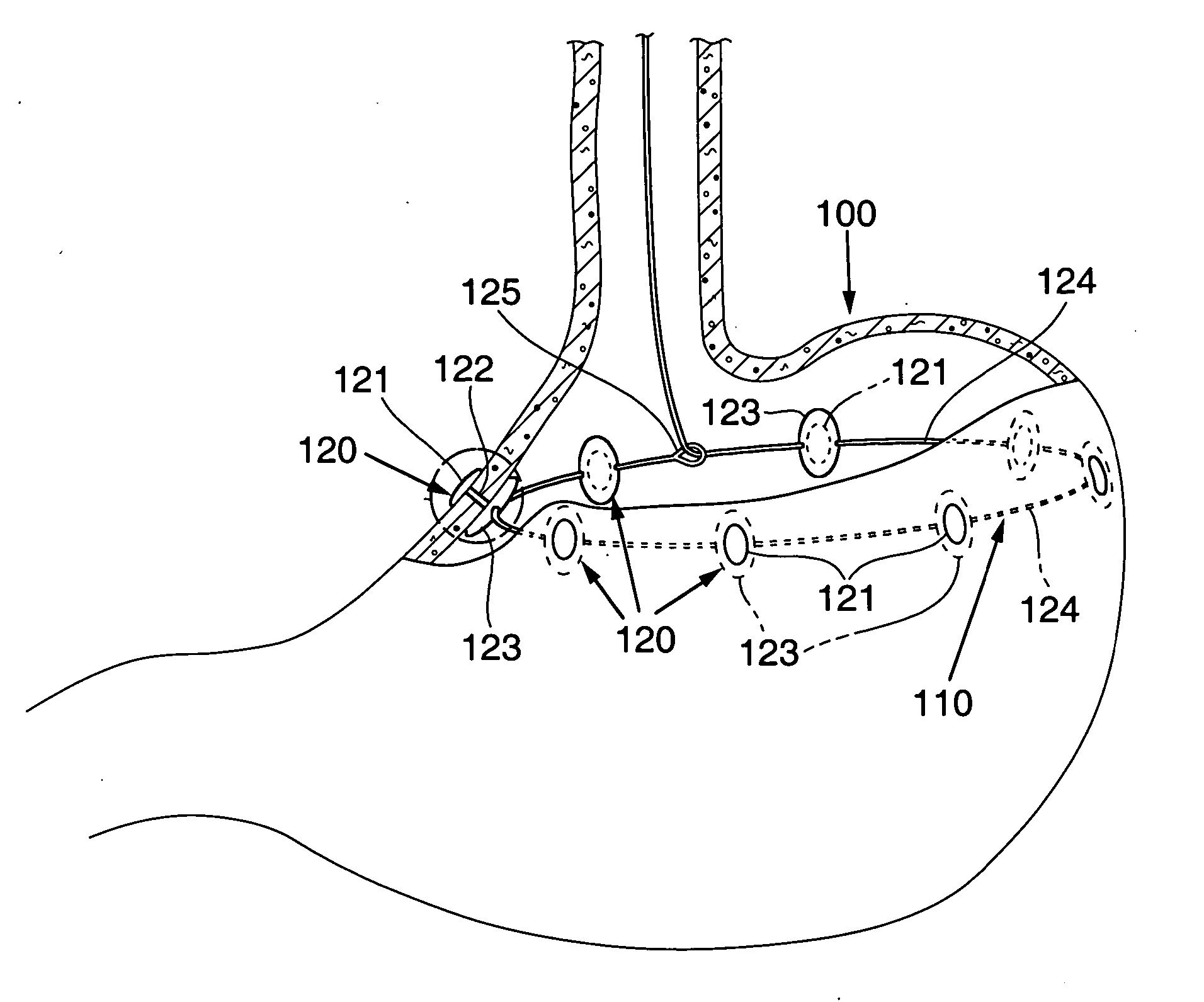 Endoscopic gastric constriction device