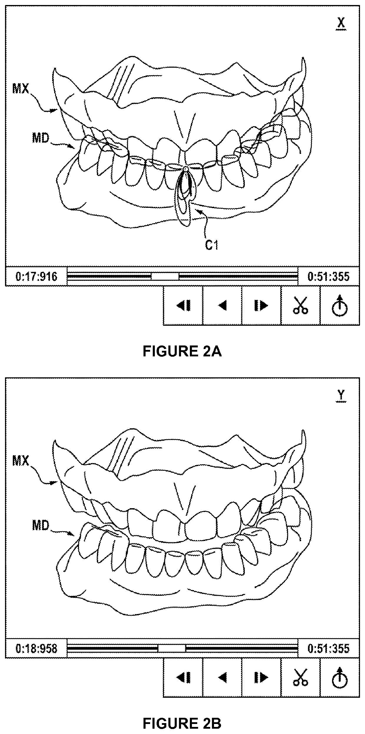 Method for animating models of the mandibular and maxillary arches of a patient in a corrected intermaxillary relationship