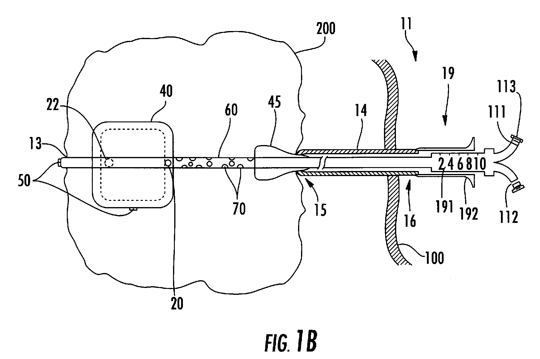 Process and device for selectively treating interstitial tissue