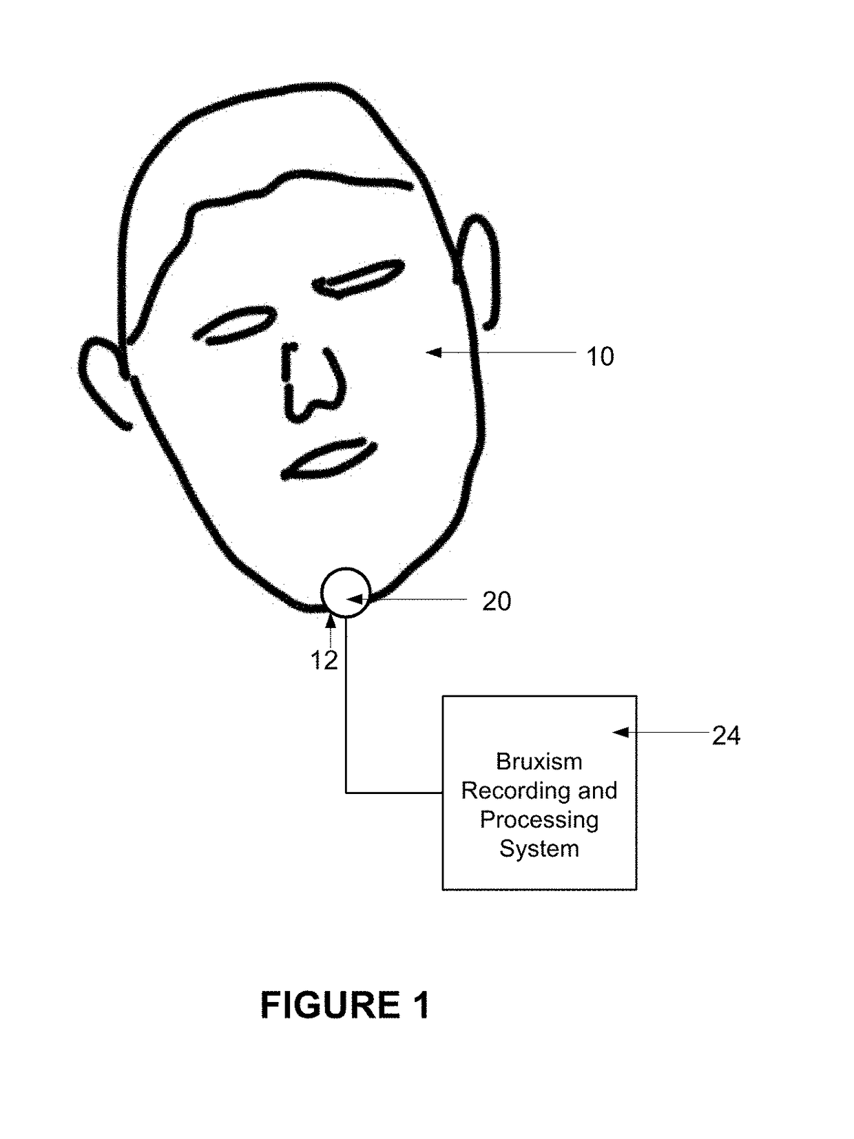 Bruxism Detection System With Chin-Mounted Accelerometer Sensor
