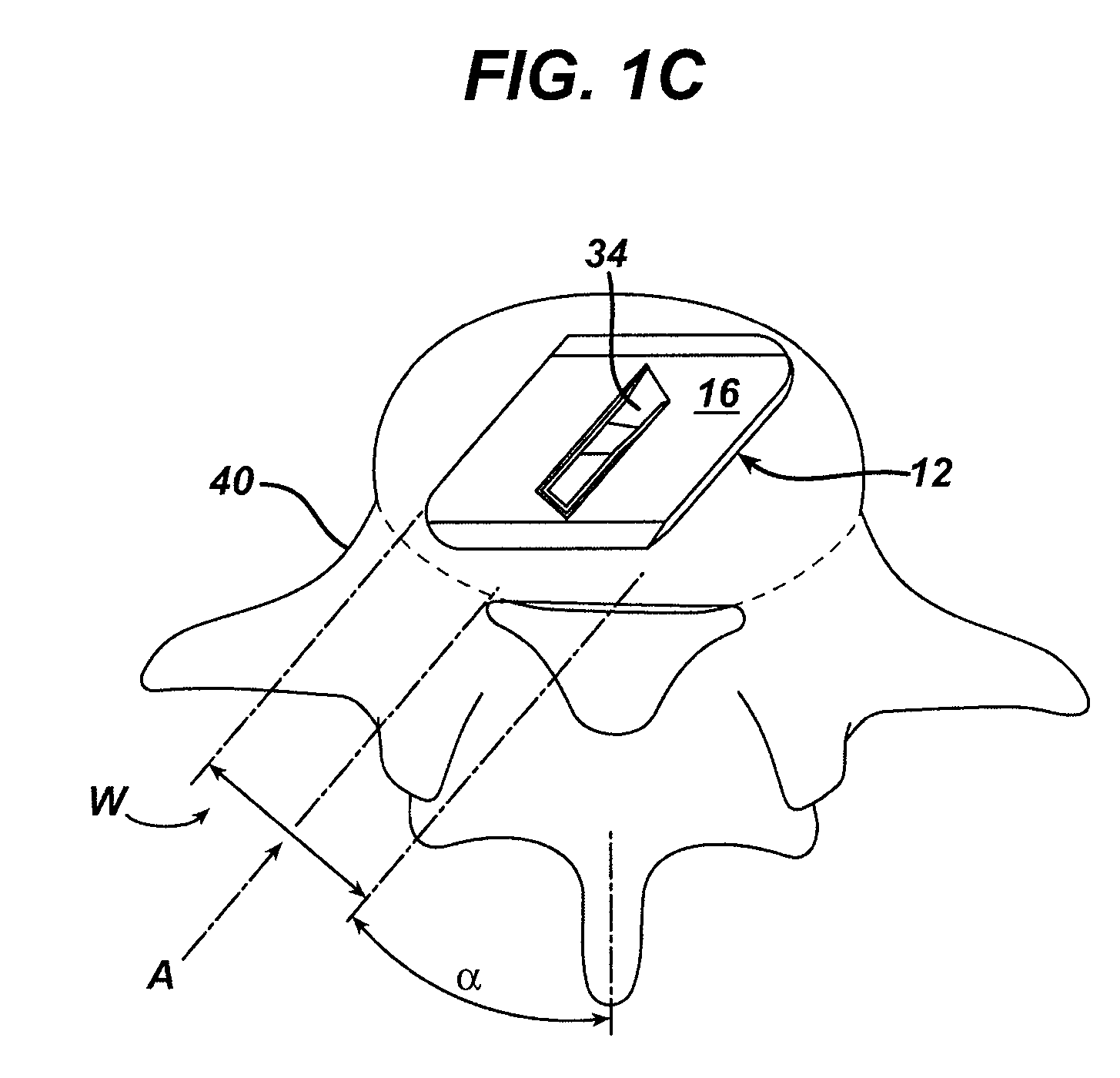 Methods and instrumentation for disc replacement