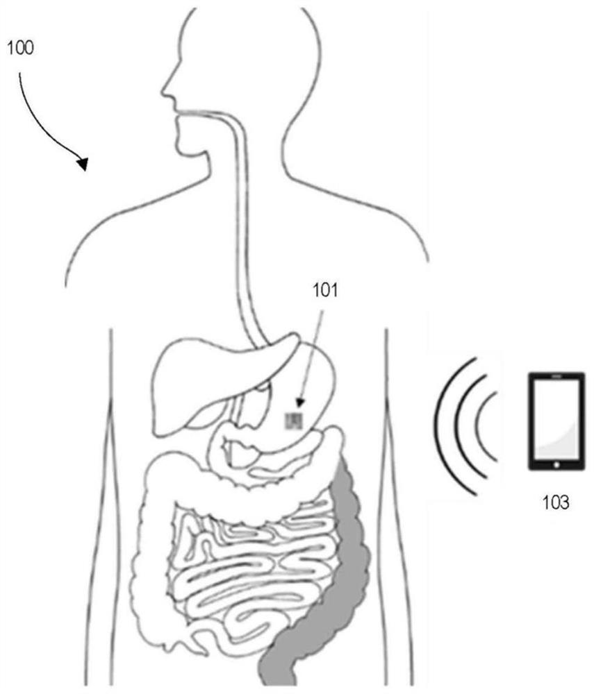 A wireless detection system for gastric pH based on edible and digestible materials