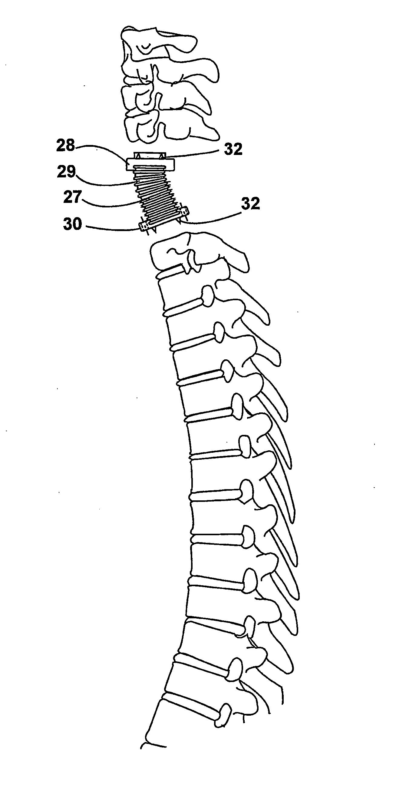 Device for implanting in a human or animal vertebral column