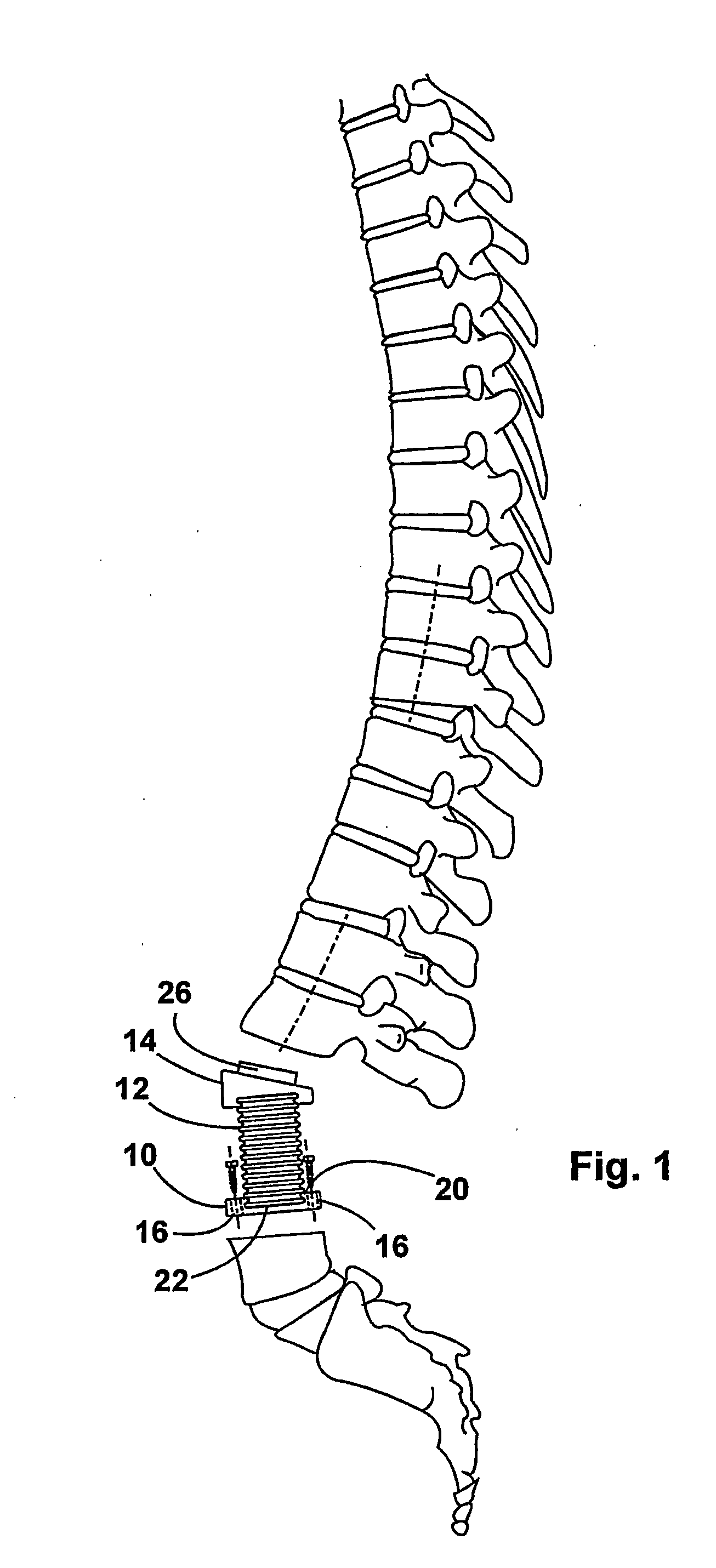 Device for implanting in a human or animal vertebral column