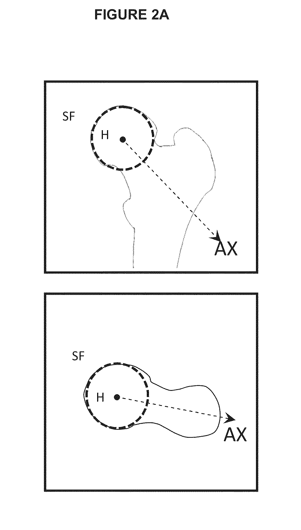 Method for determining bone resection on a deformed bone surface from few parameters