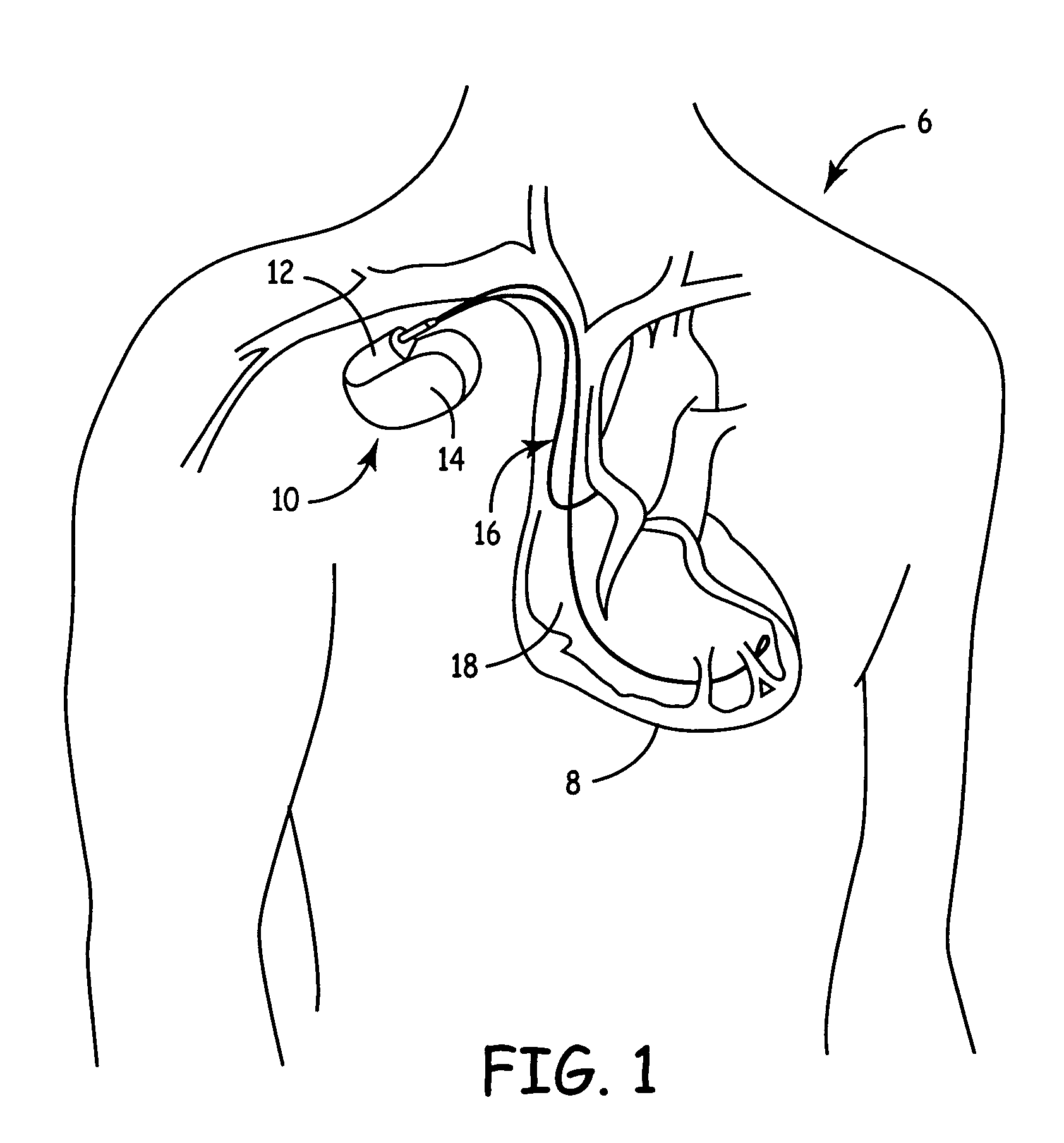 Implantable medical device with ventricular pacing protocol