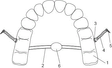 Device for integrally lowering posterior tooth segments