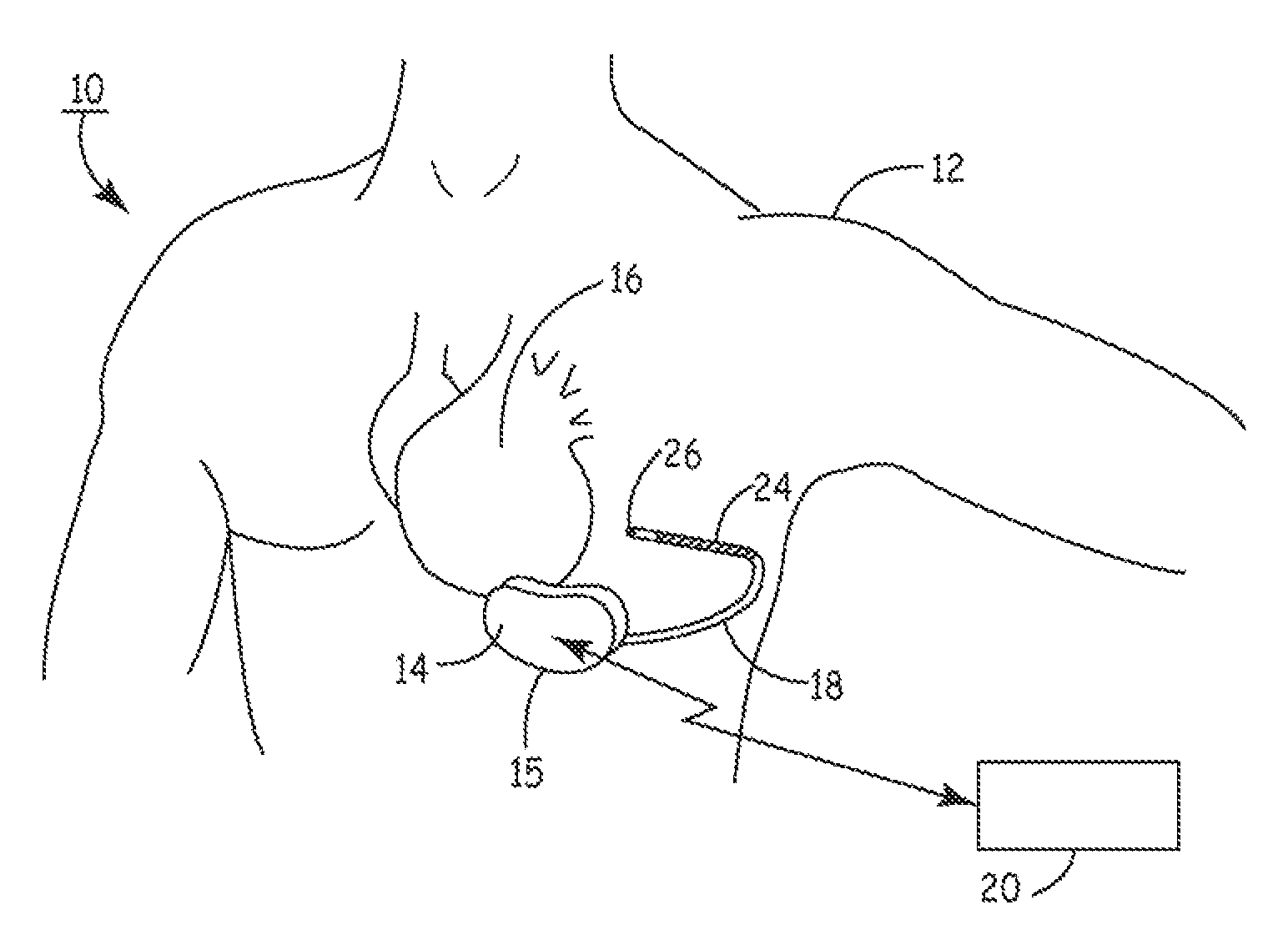 Method and apparatus for detecting arrhythmias in a subcutaneous medical device