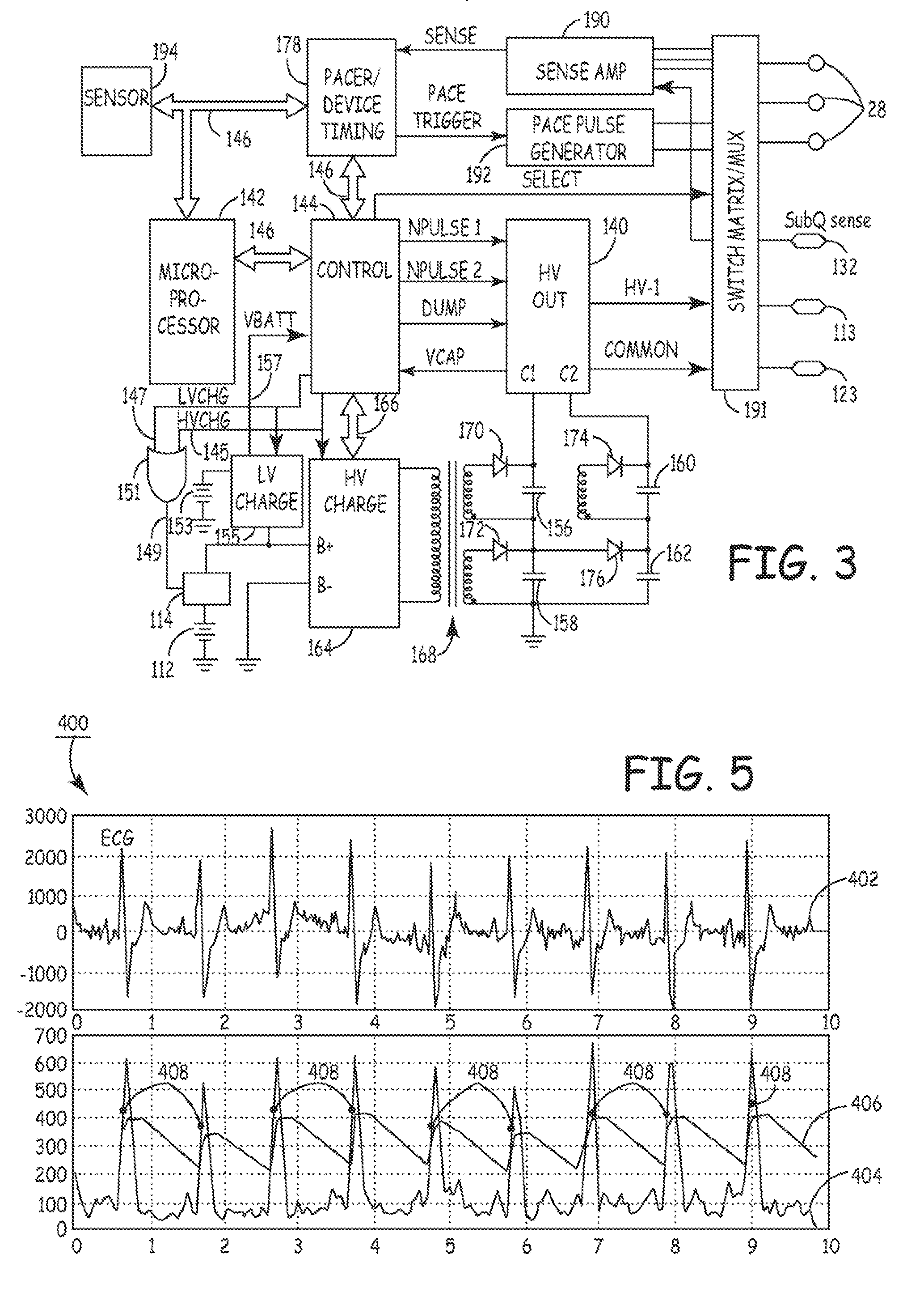 Method and apparatus for detecting arrhythmias in a subcutaneous medical device