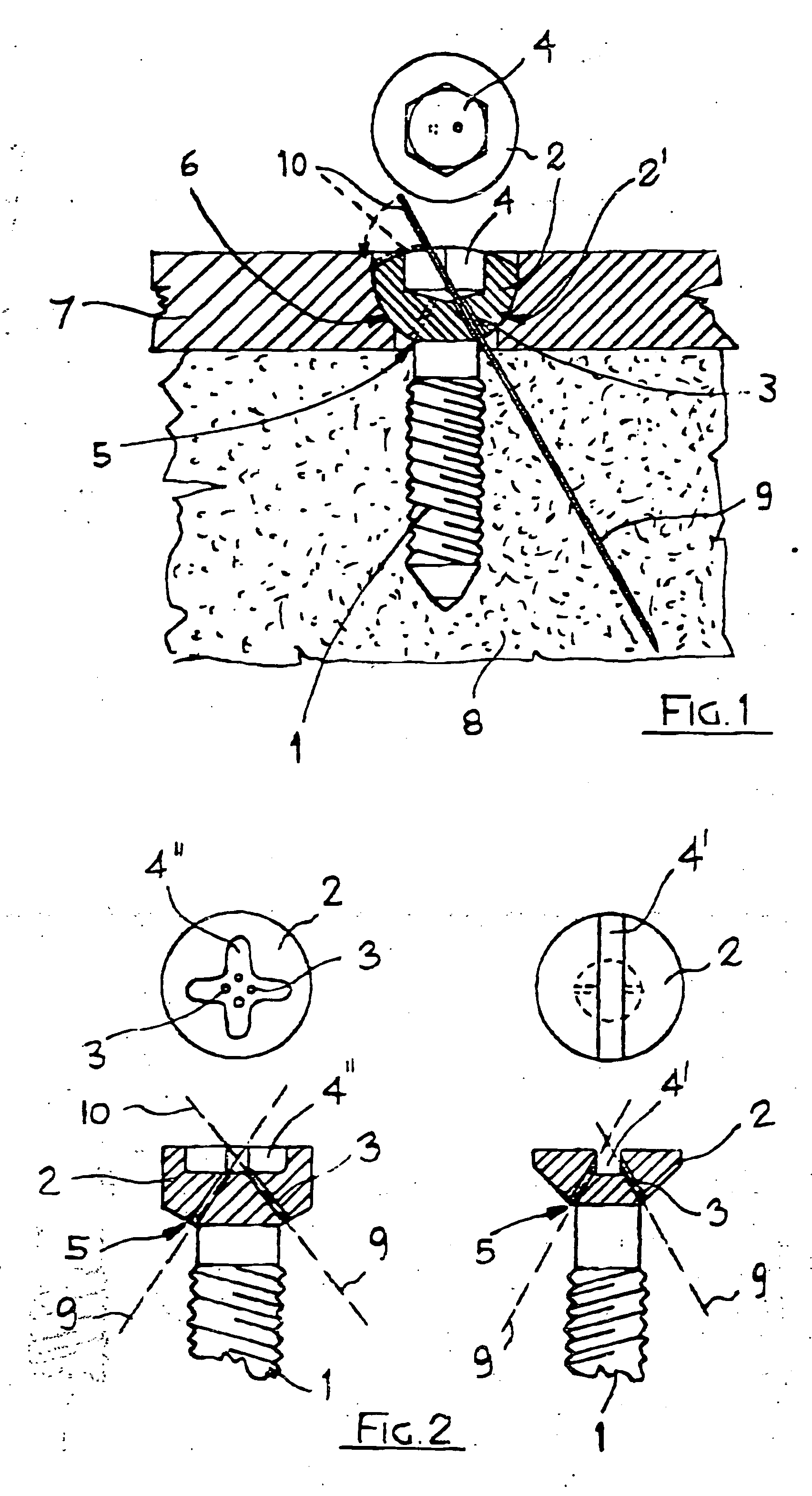 Surgical screw with spontaneous loosening preventive blocking system