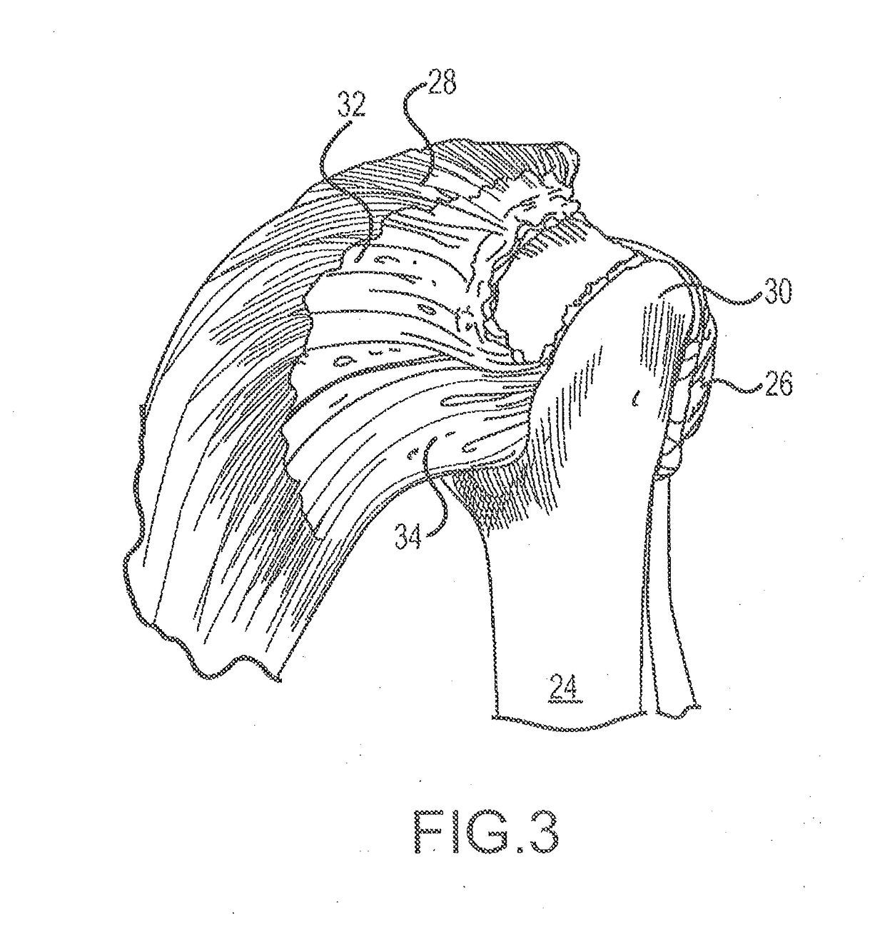 Suture sleeve patch and methods of delivery within an existing arthroscopic workflow