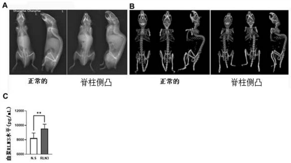 Application of RXFP1/3 inhibitor in preparation of medicine for preventing or treating adolescent idiopathic scoliosis disease