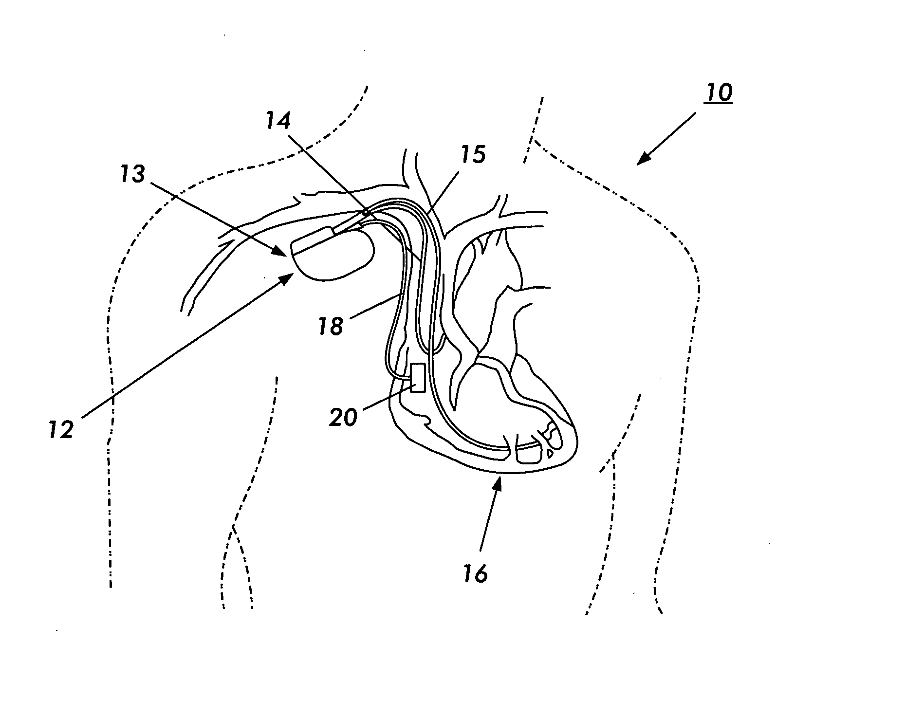 Fibrillation/tachycardia monitoring and preventive system and methodology