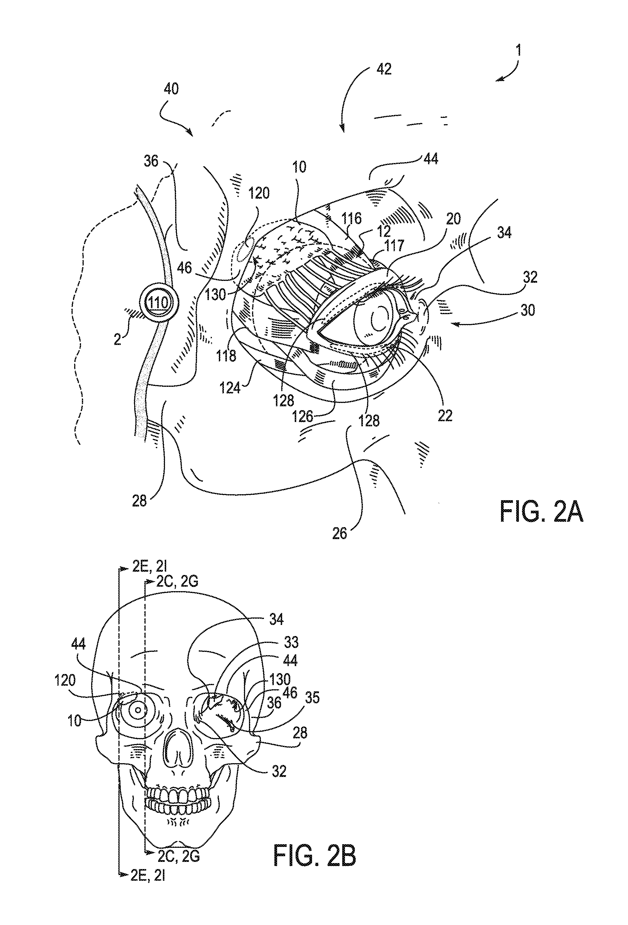Systems and methods for treatment of dry eye
