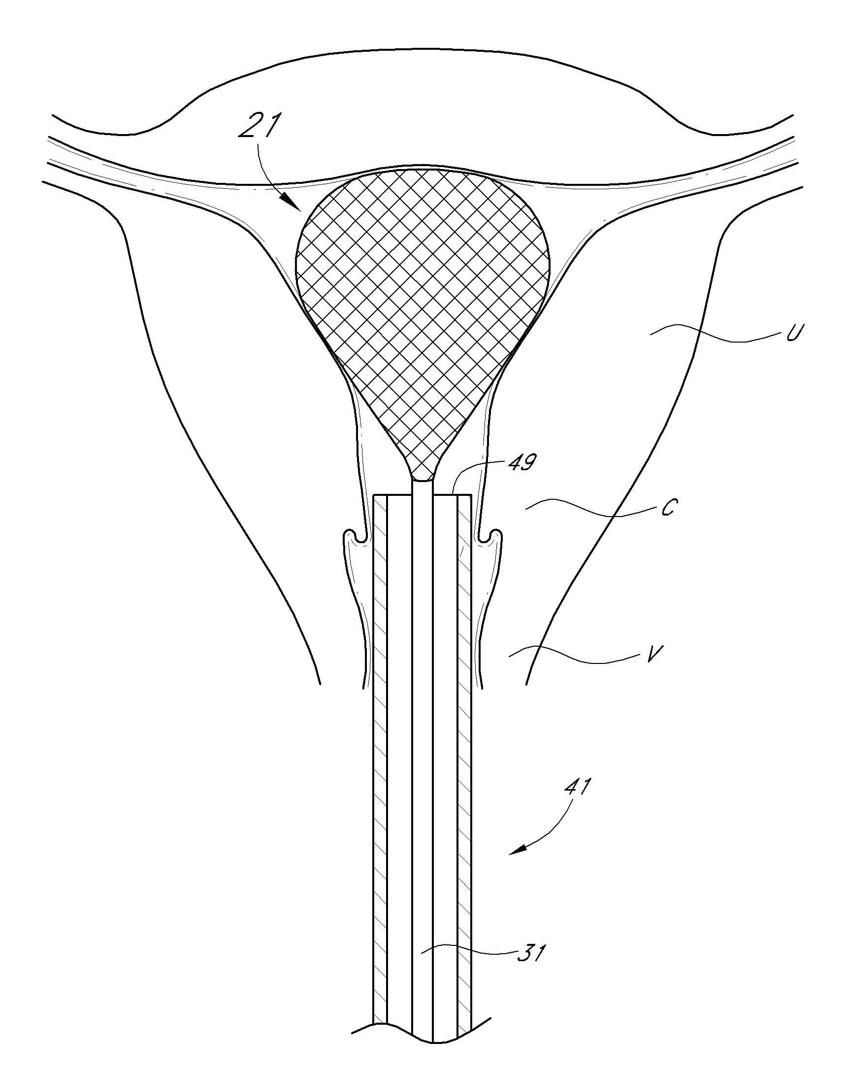 Method and device for distending a gynecological cavity