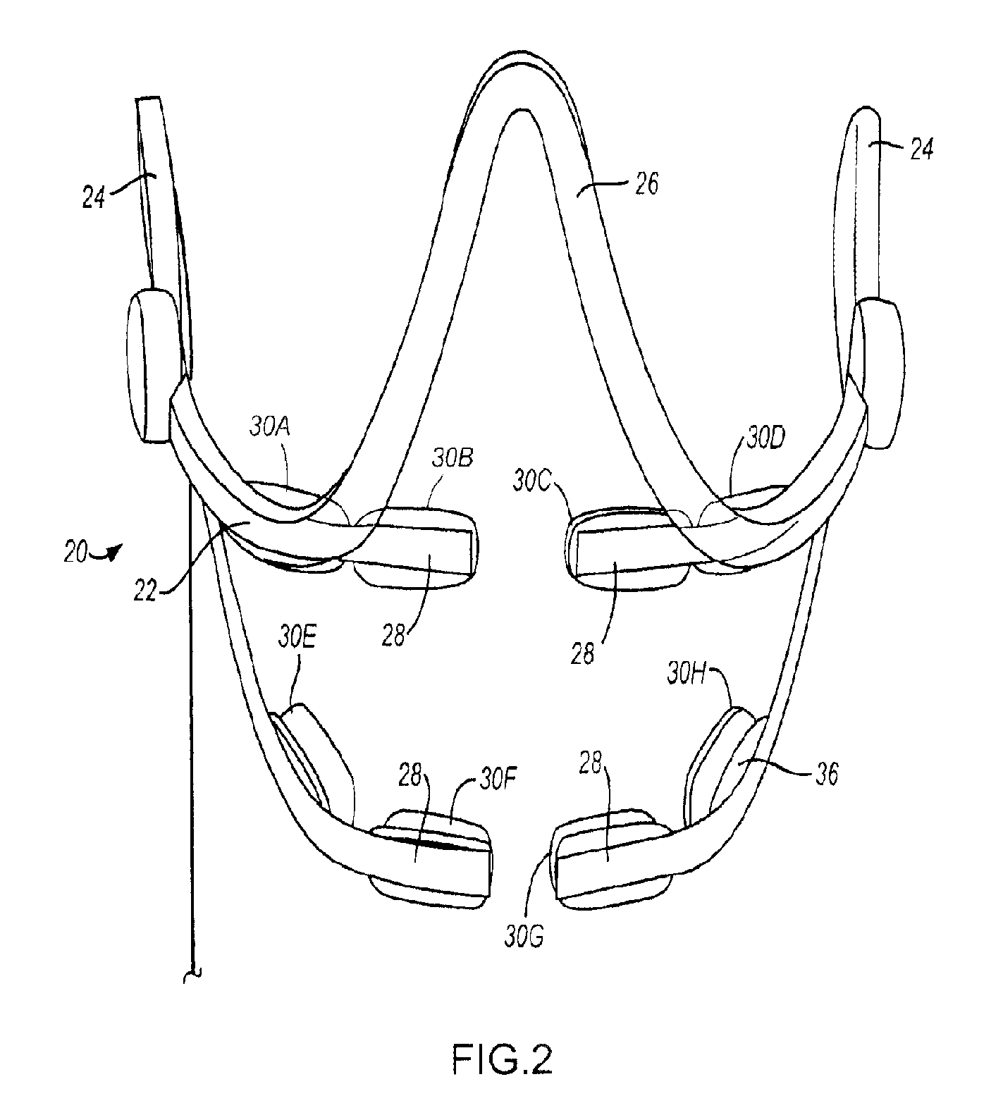 Method and apparatus for tooth regulation with heavy forces