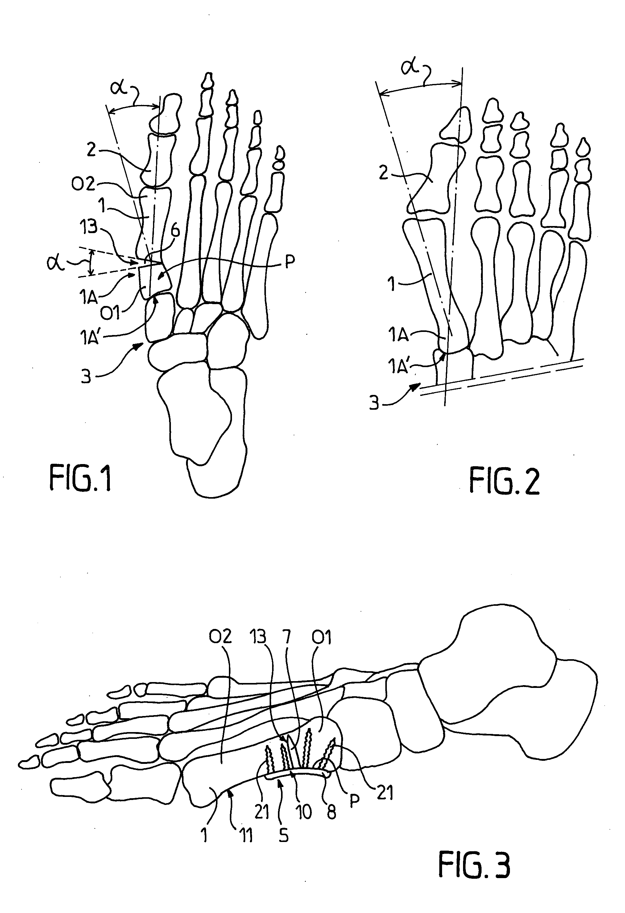 Fastener implant for osteosynthesis of fragments of a first metatarsal bone that is broken or osteotomized in its proximal portion and a corresponding osteosynthesis method