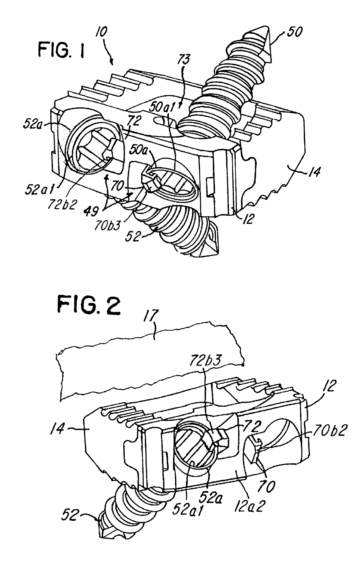 Spinal implant and assembly