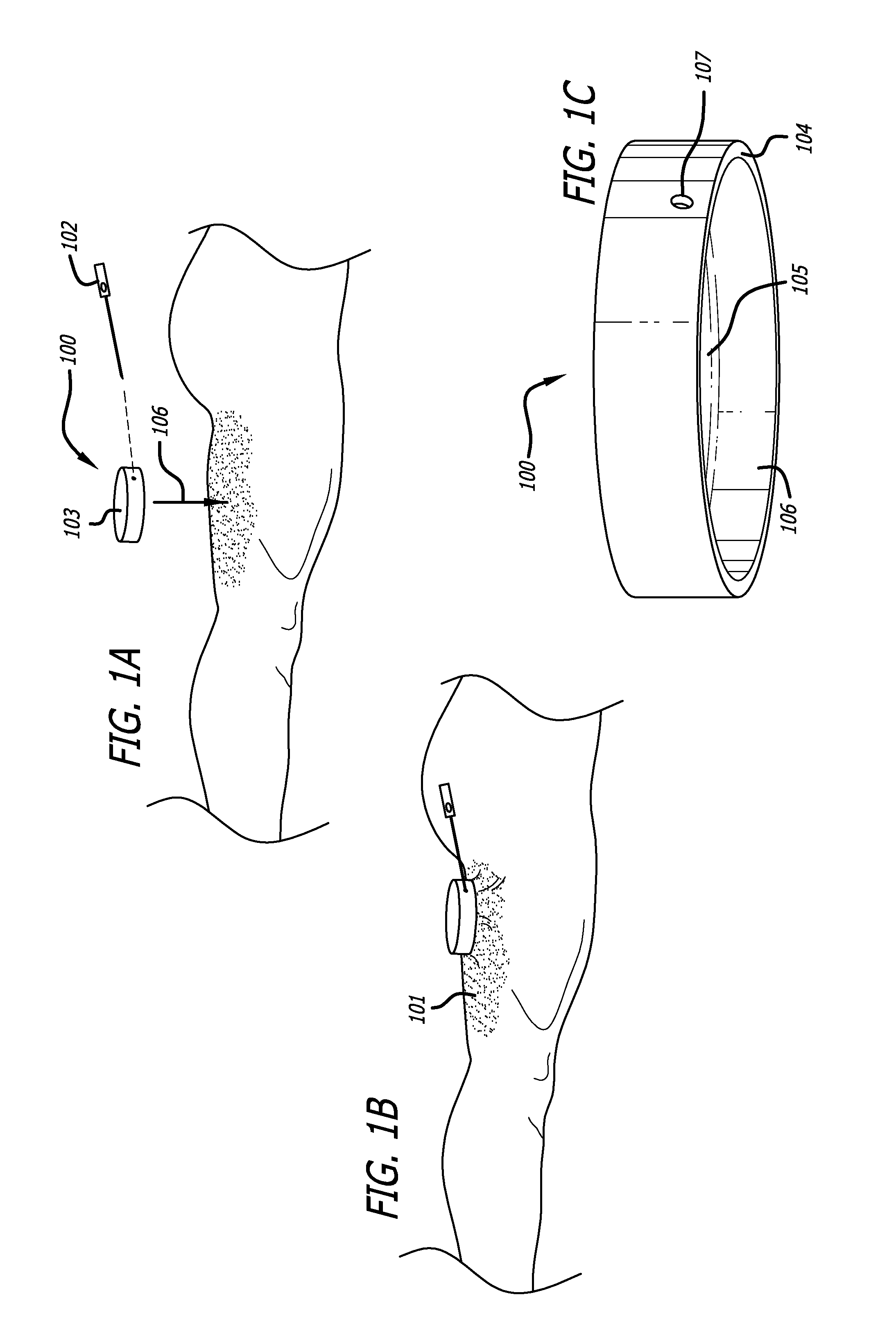Handpiece and methods for performing subcutaneous surgery