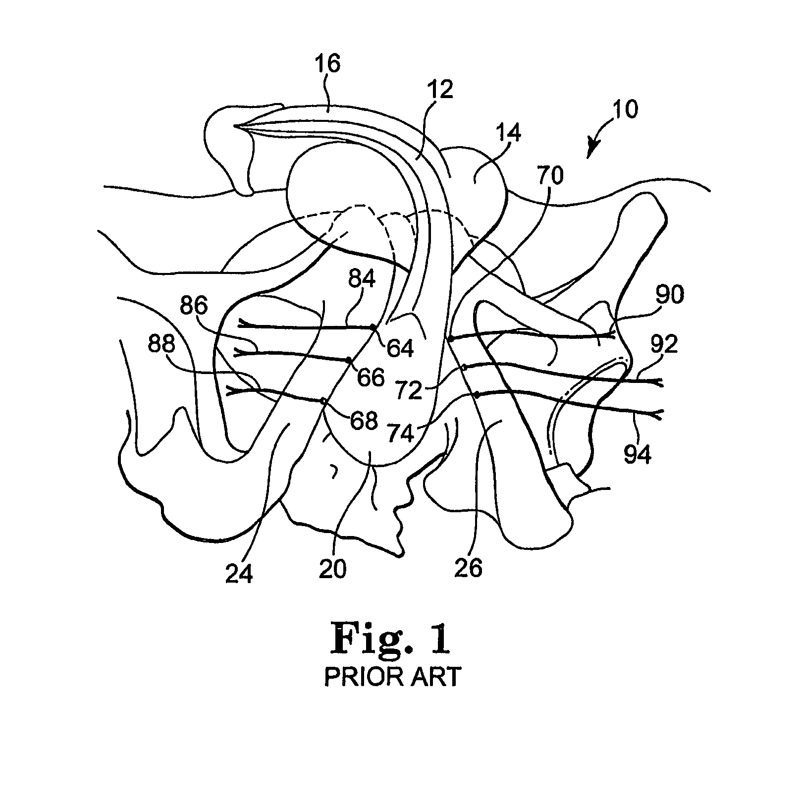 Methods and apparatus for securing a urethral sling to a pubic bone