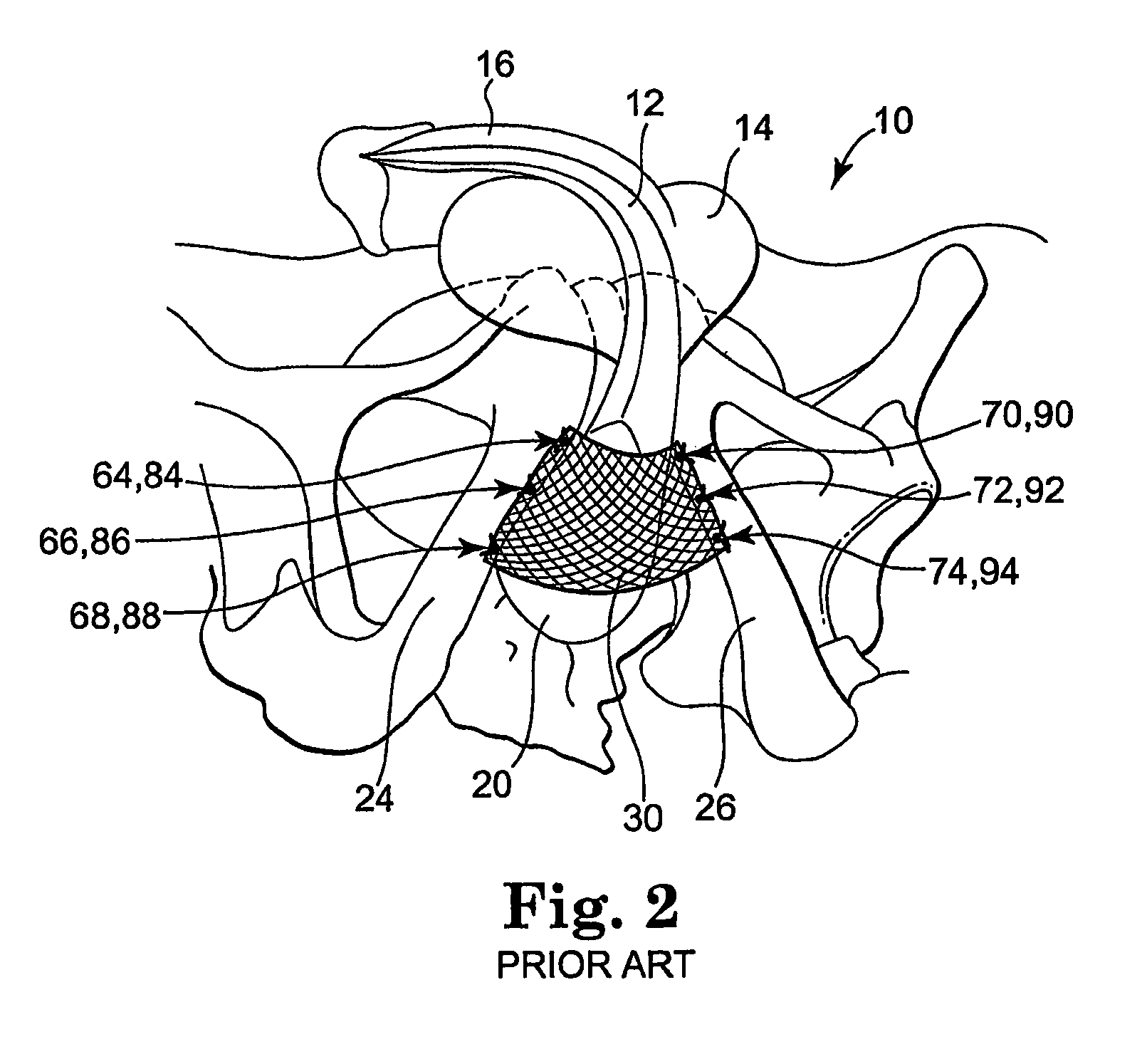 Methods and apparatus for securing a urethral sling to a pubic bone