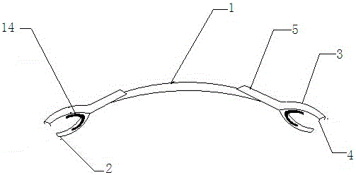 A device for delaying the closing of the sternum and the sternum