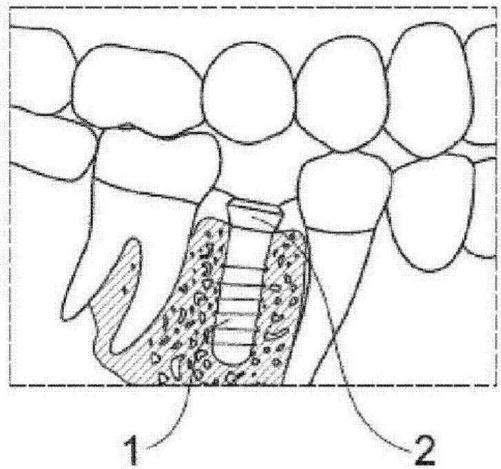 Coating of dental prosthetic surfaces comprising distinct layer of synthetic hydroxyapatite