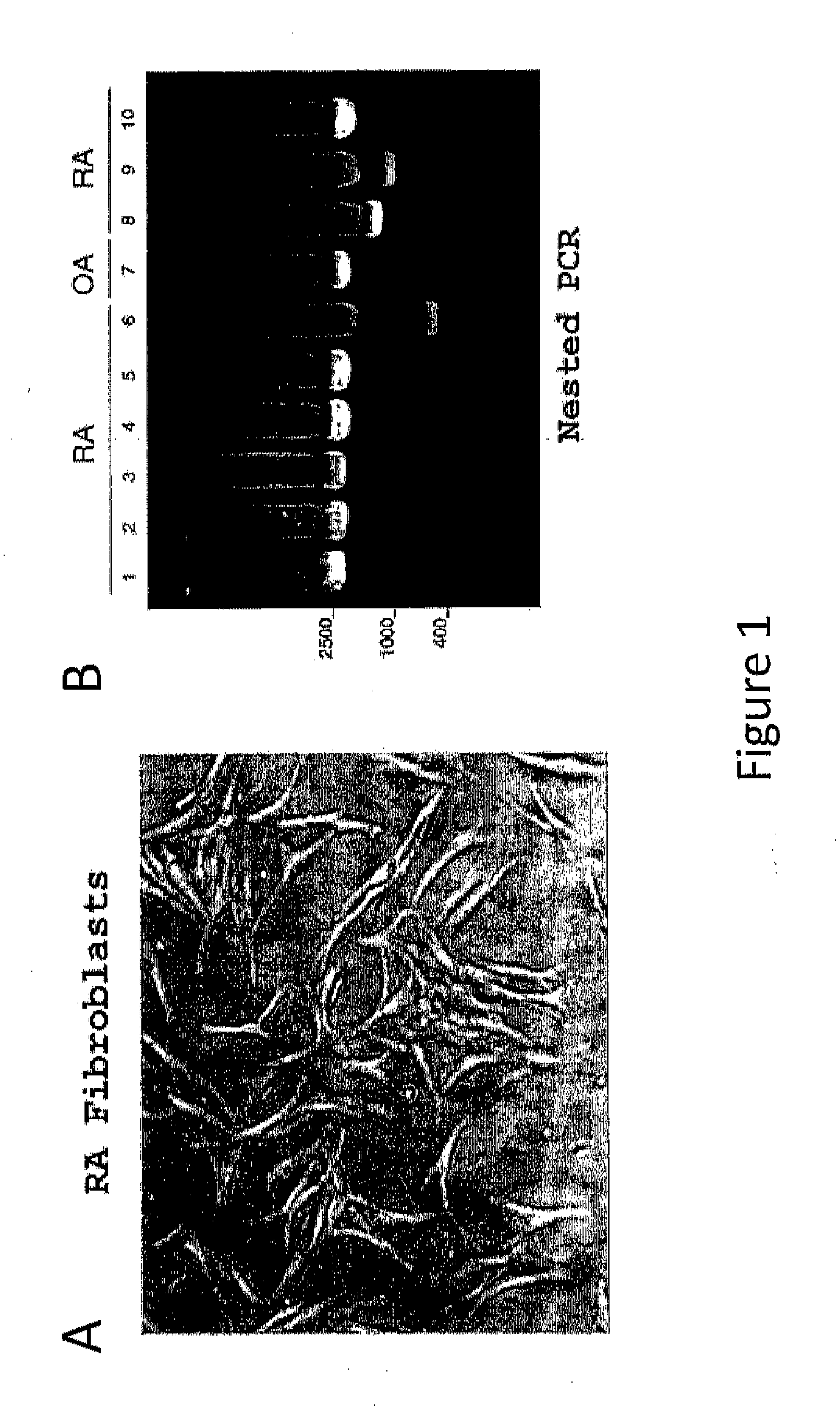 Methods for determining and inhibiting rheumatoid arthritis associated with the braf oncogene in a subject