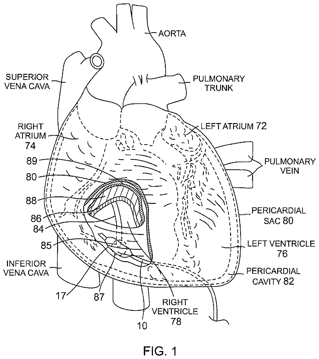 Pericardial catheter with temperature sensing array