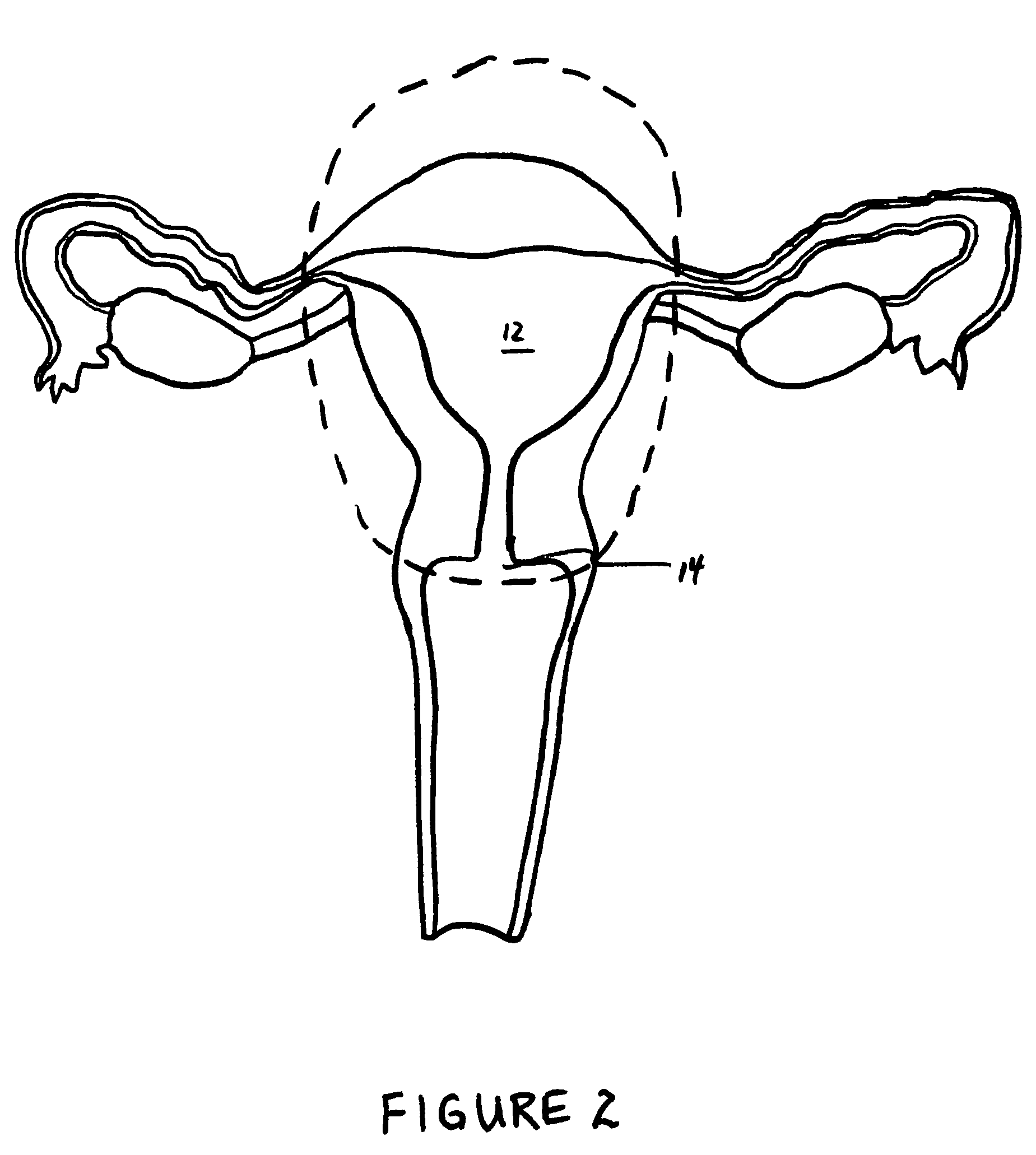 Method and apparatus for creating intrauterine adhesions