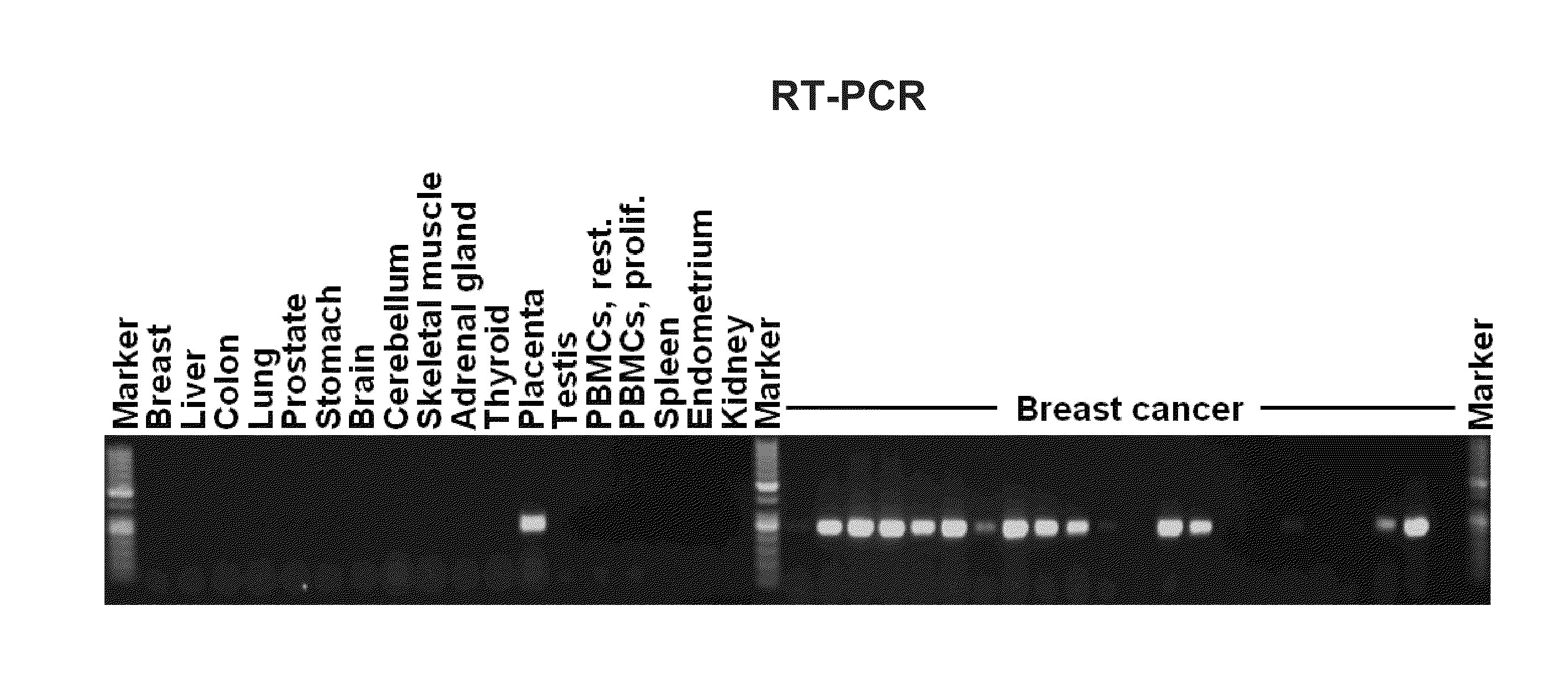 Identification of Tumor-Associated Markers for Diagnosis and Therapy