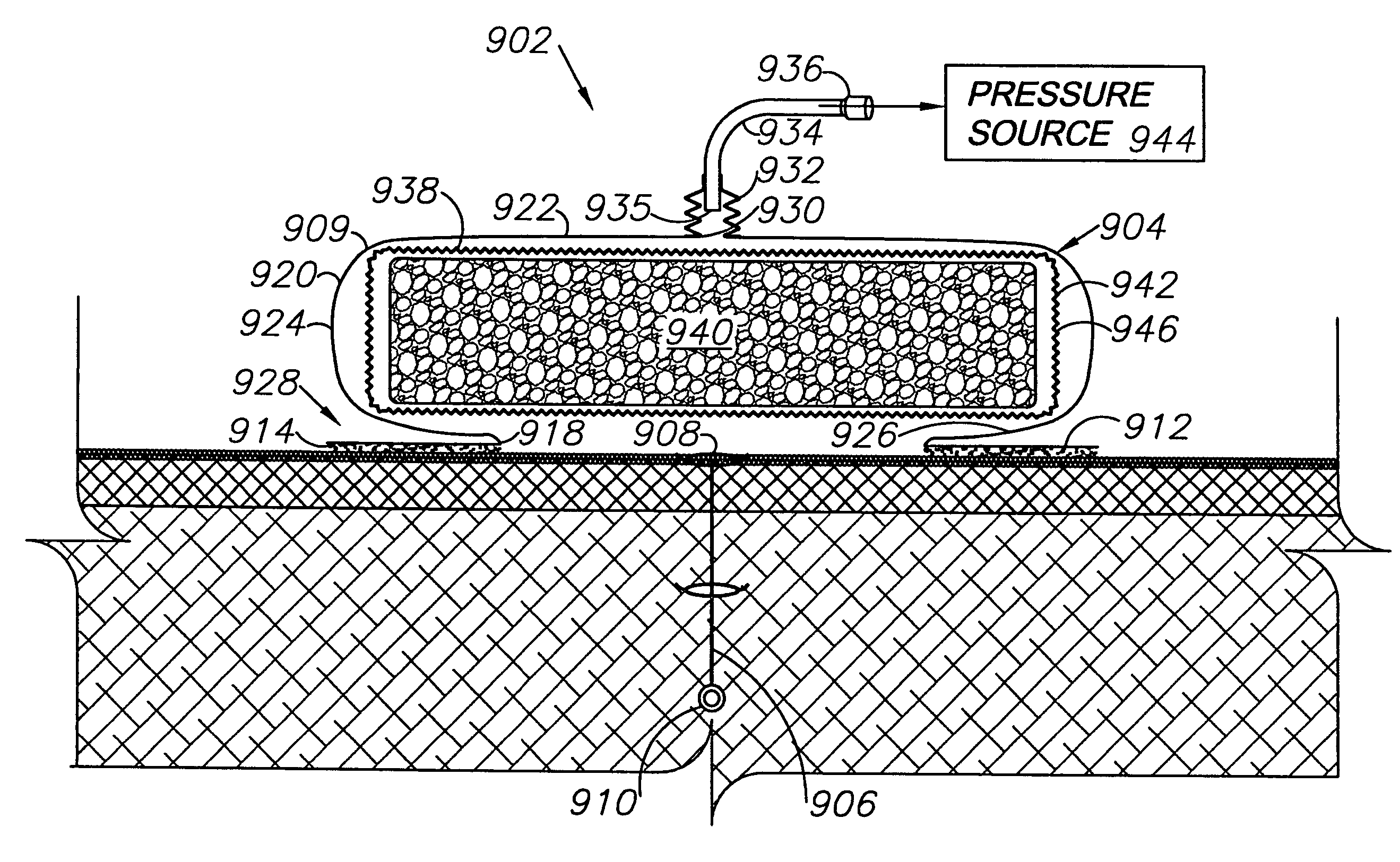 Externally-applied patient interface system and method