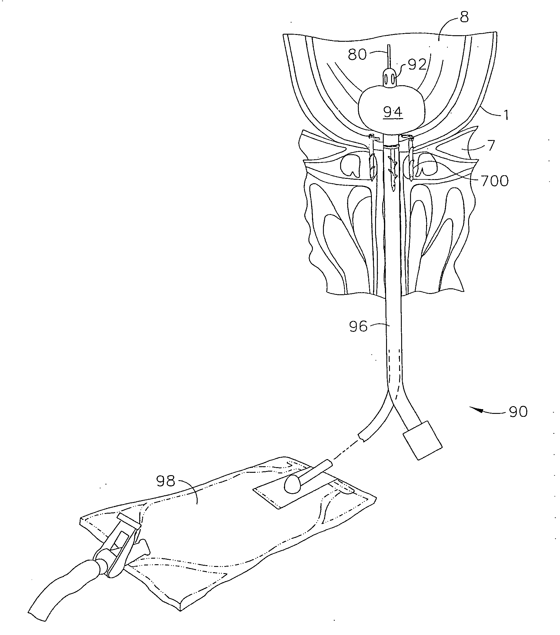 Method and instrument for effecting anastomosis of respective tissues defining two body lumens