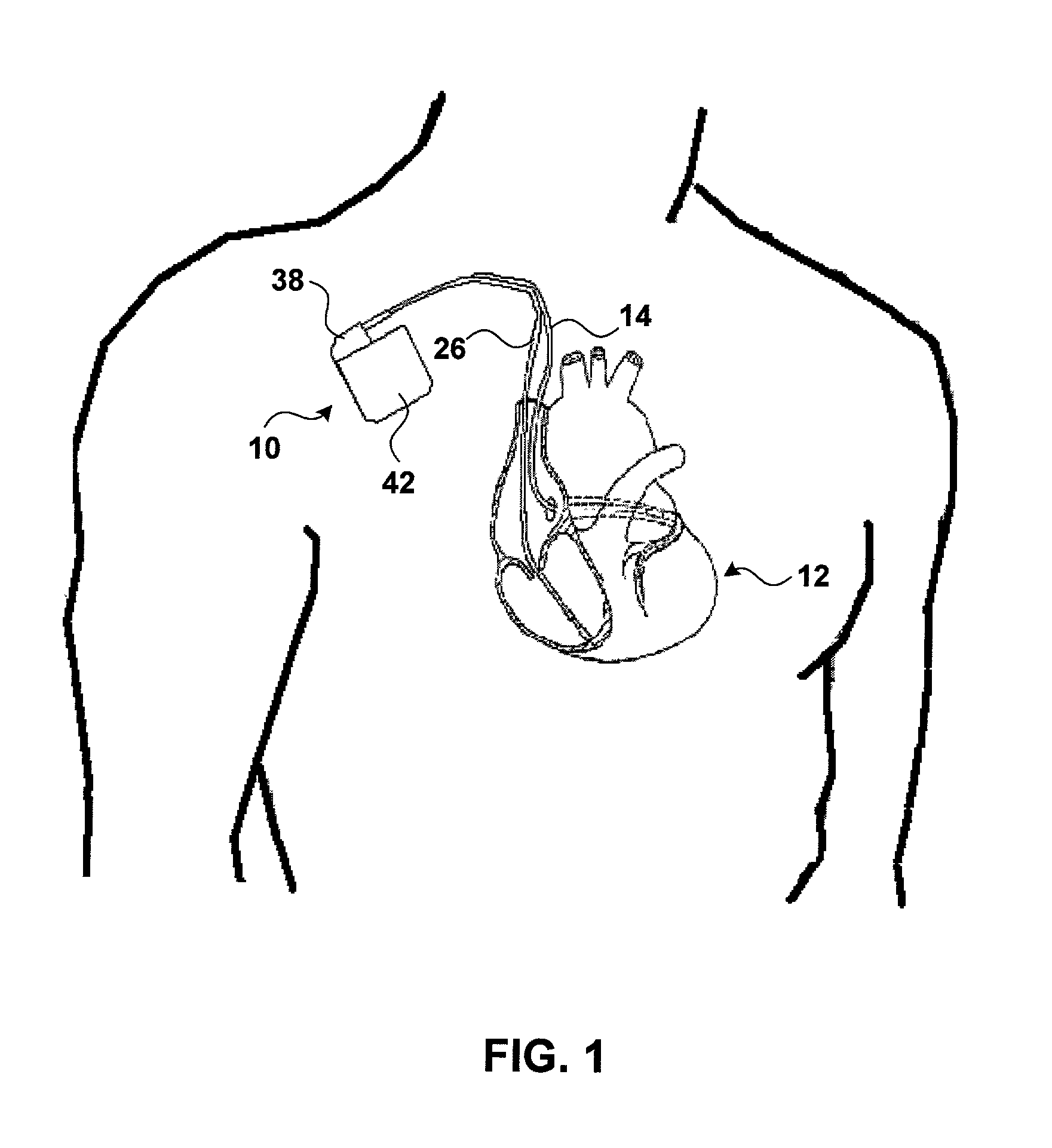 Anti-tachycardia pacing based on multi-site electrograms