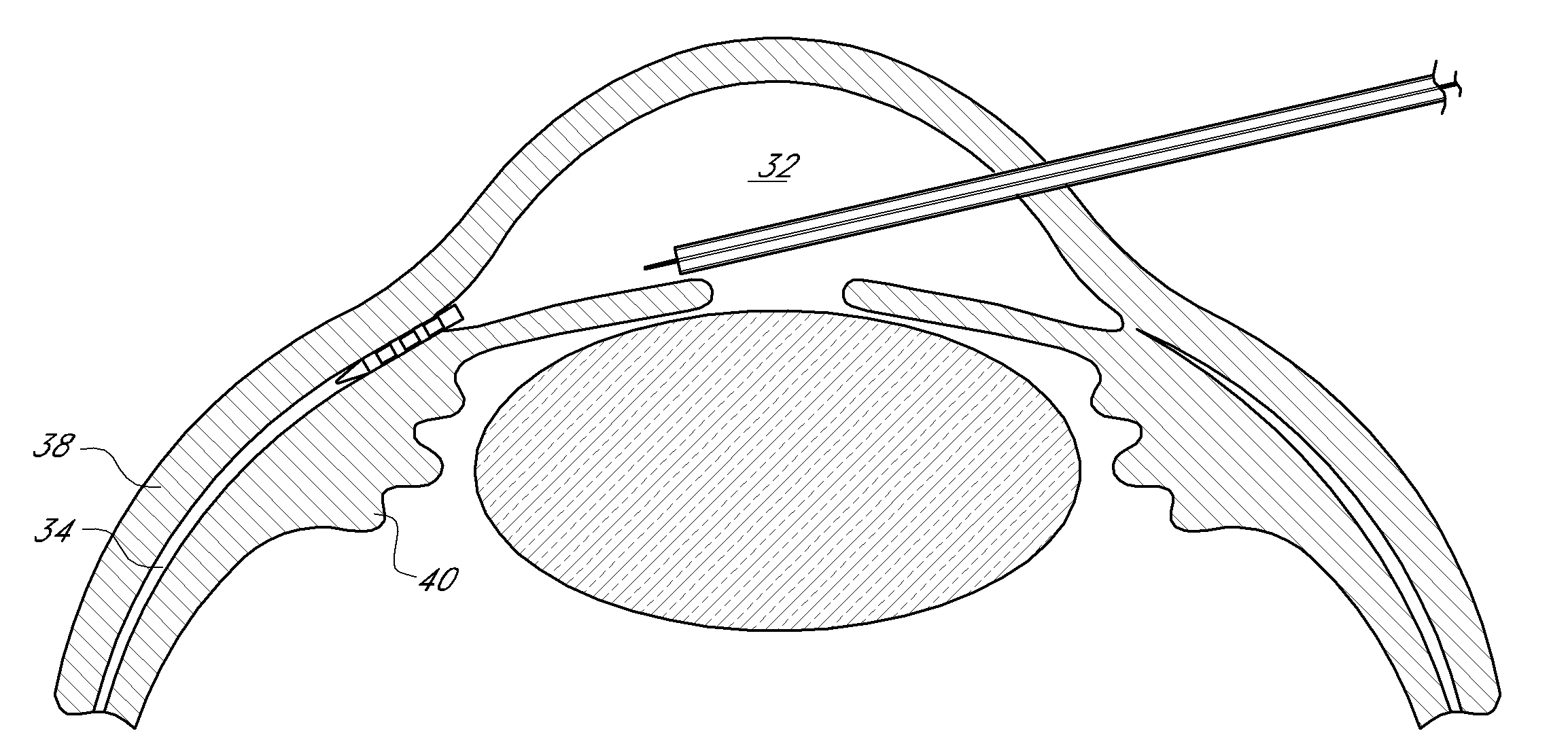 Uveoscleral shunt and methods for implanting same