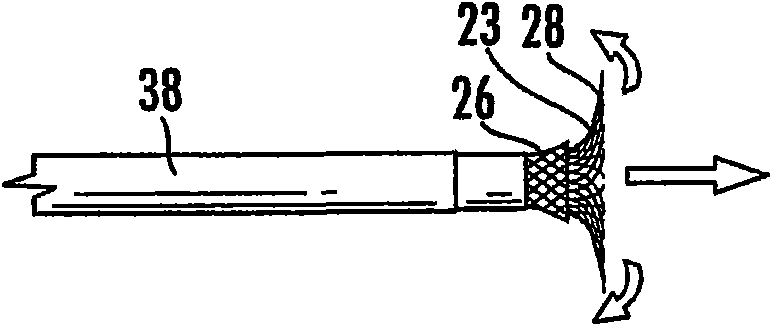 Stent graft for reinforcement of vascular abnormalities and associated method