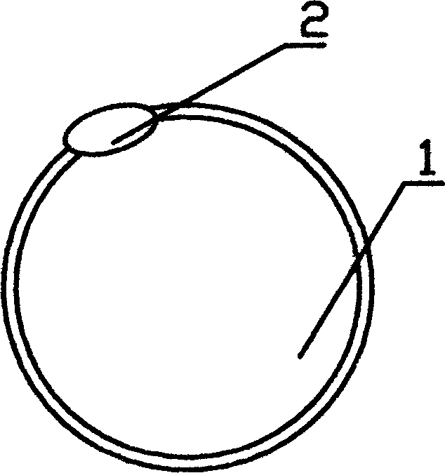 Duodenum casing for treating diabetes implanted under endoscope