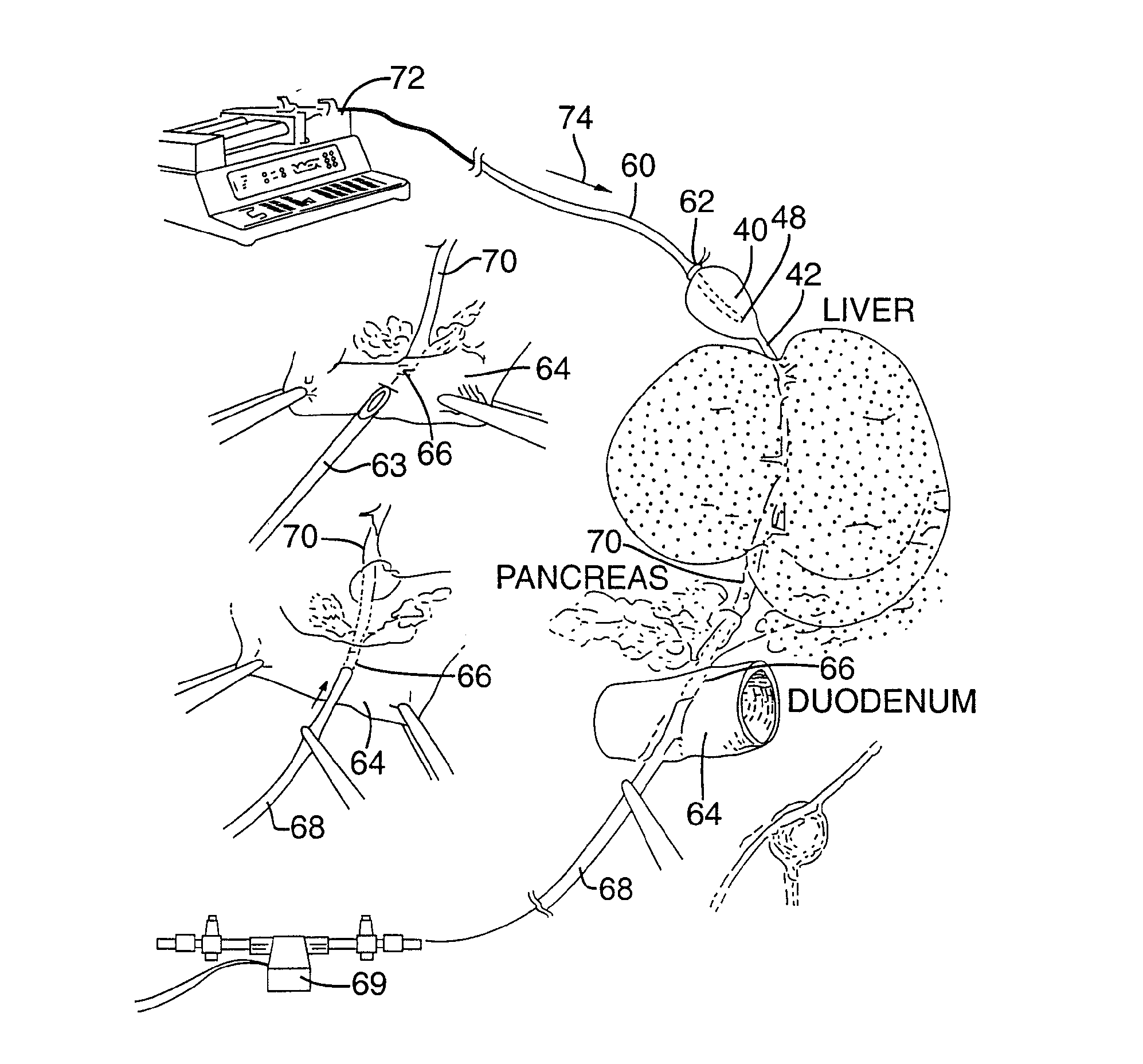 Method for pressure mediated selective delivery of therapeutic substances and cannula