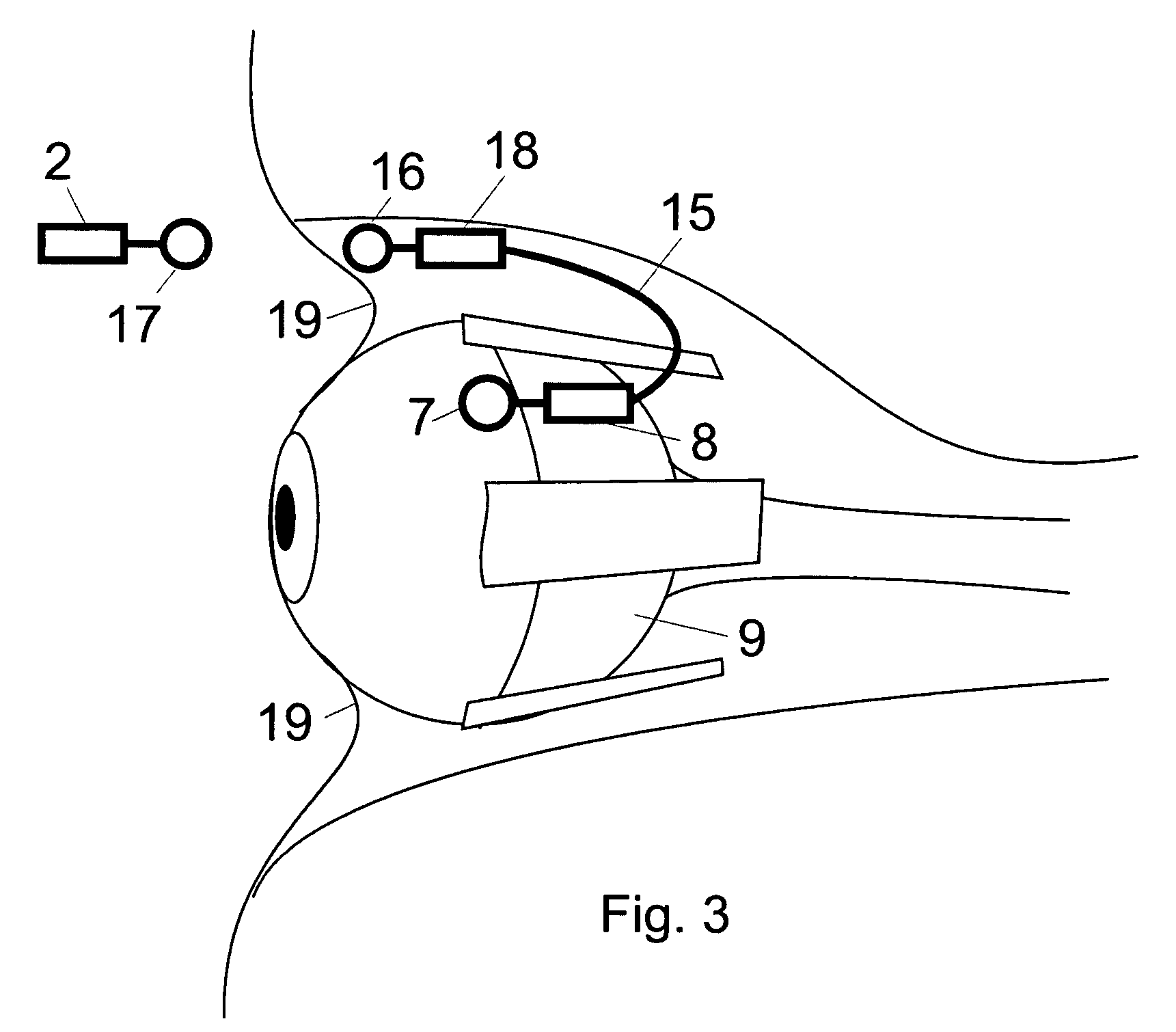 Retinal implant with improved implantation and working properties