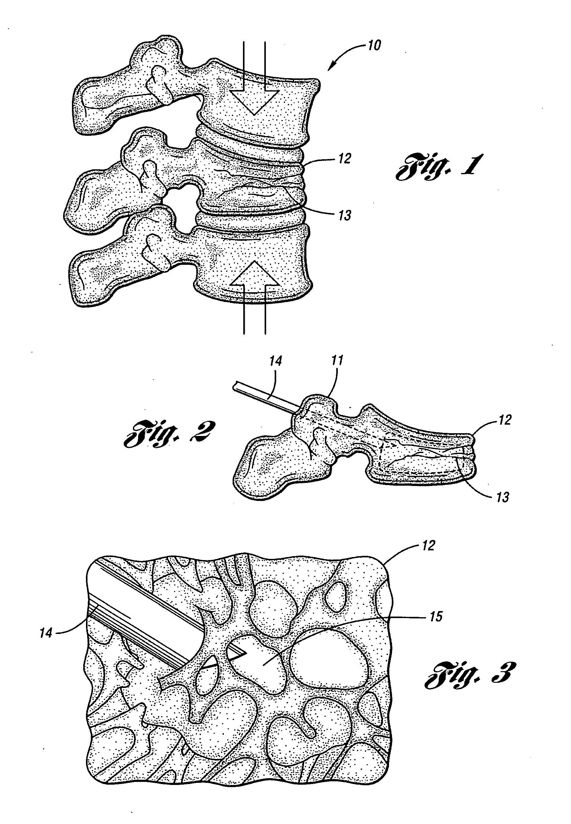 Vertebroplasty all in one mixer