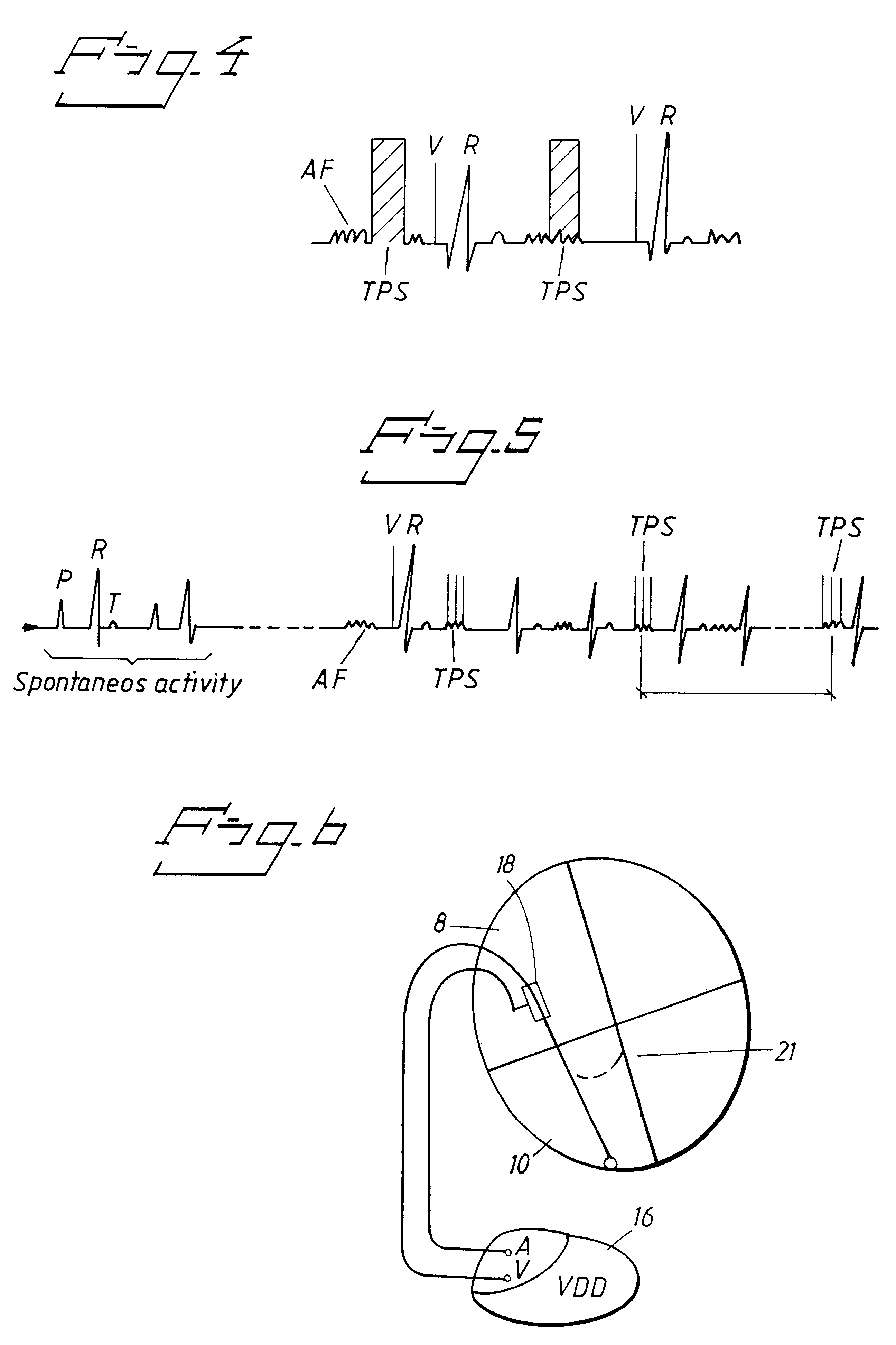 Heart stimulator for administering antithrombus therapy