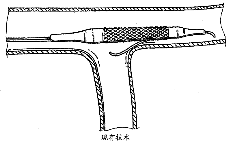 Navigation guide wire through an anatomical structure having branched ducts