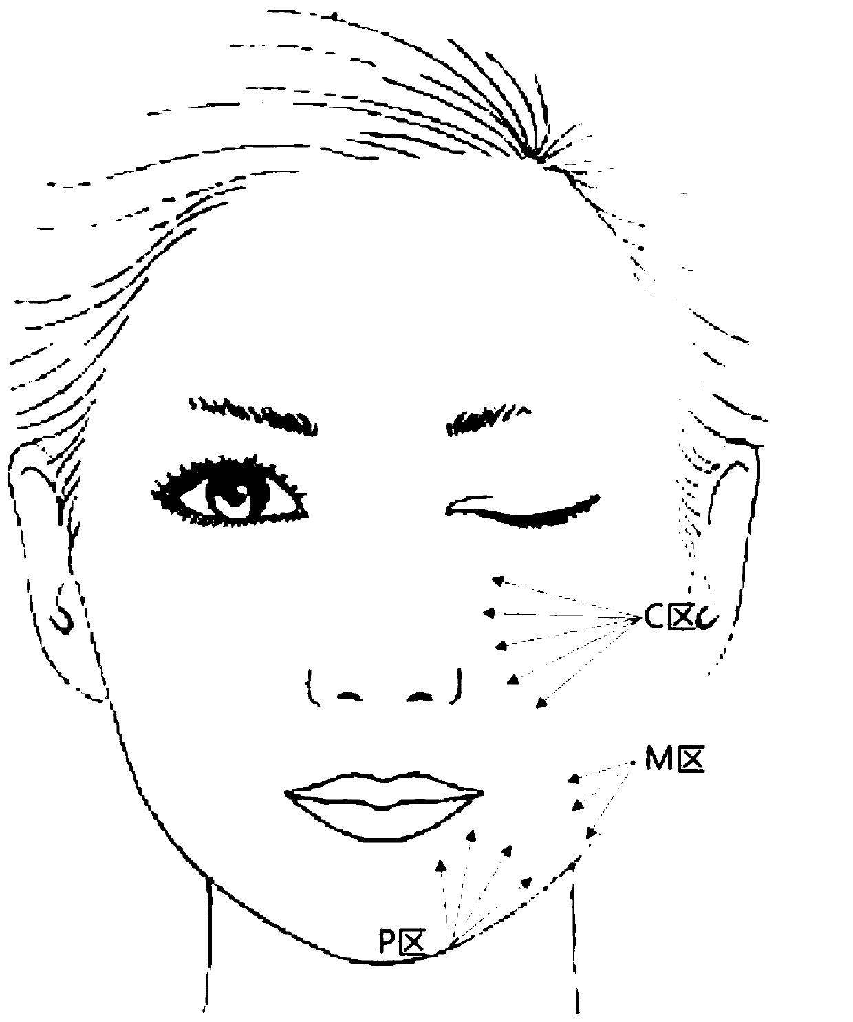 Implant for facial beauty lifting and application thereof