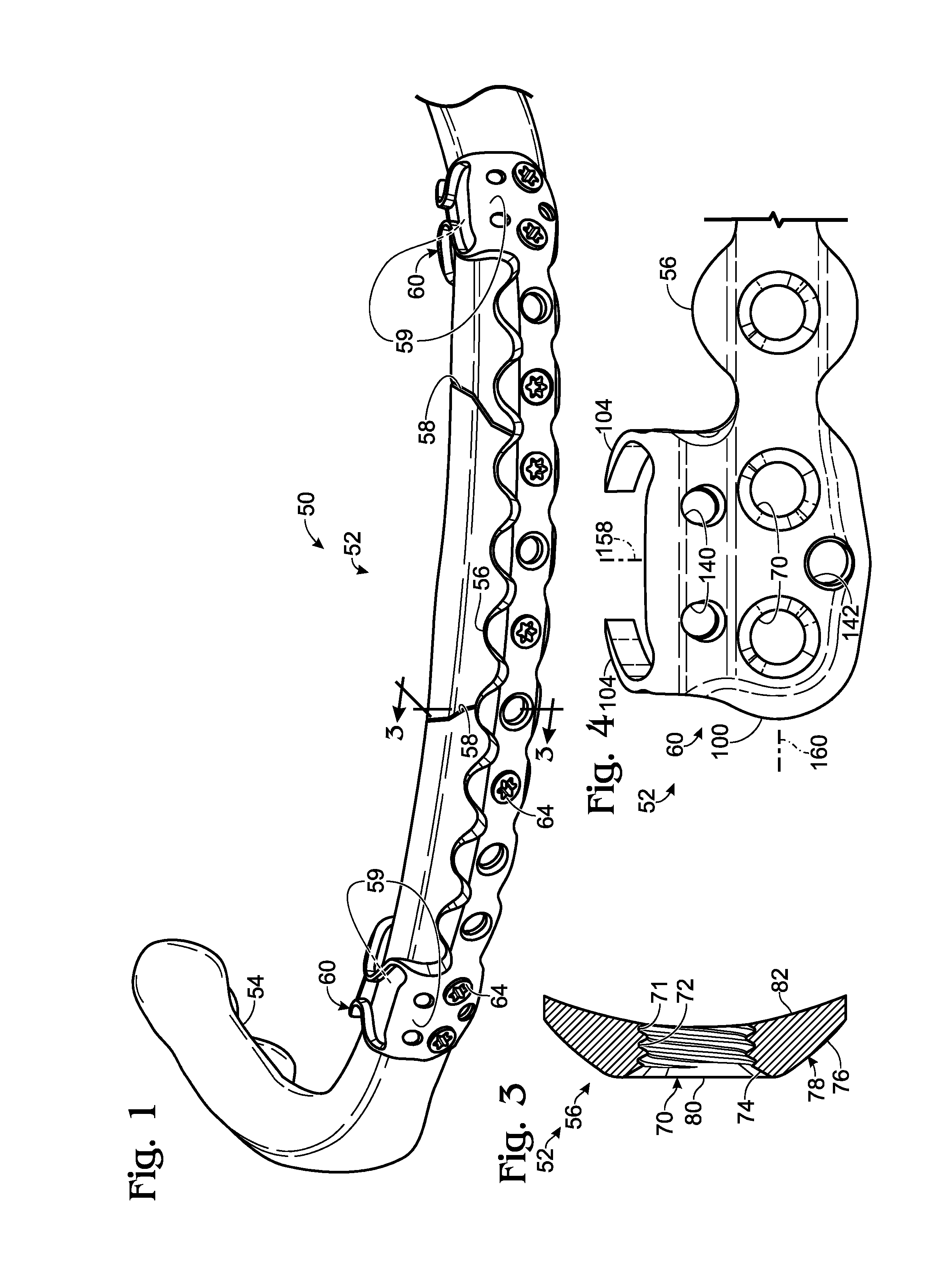 Bone fixation system with opposed mounting portions
