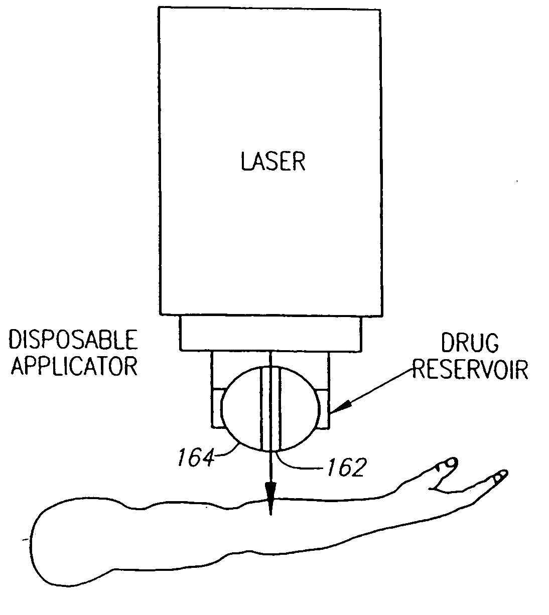 Removable tip for laser device with transparent lens