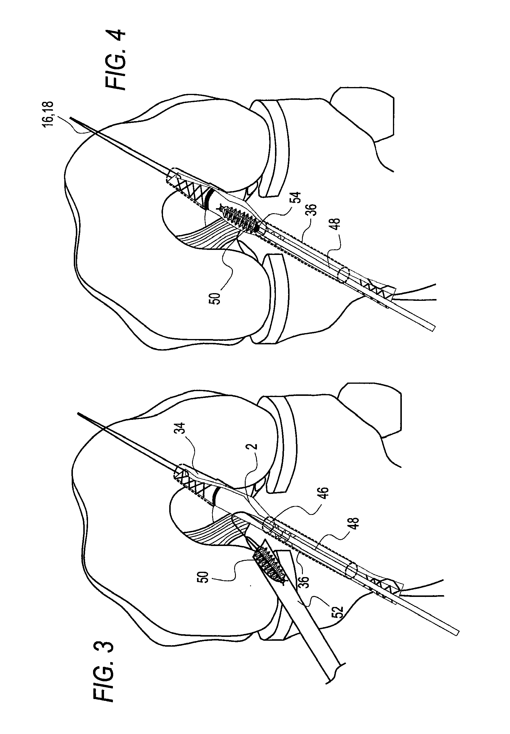 Method for creating a double bundle ligament orientation in a single bone tunnel during knee ligament reconstruction