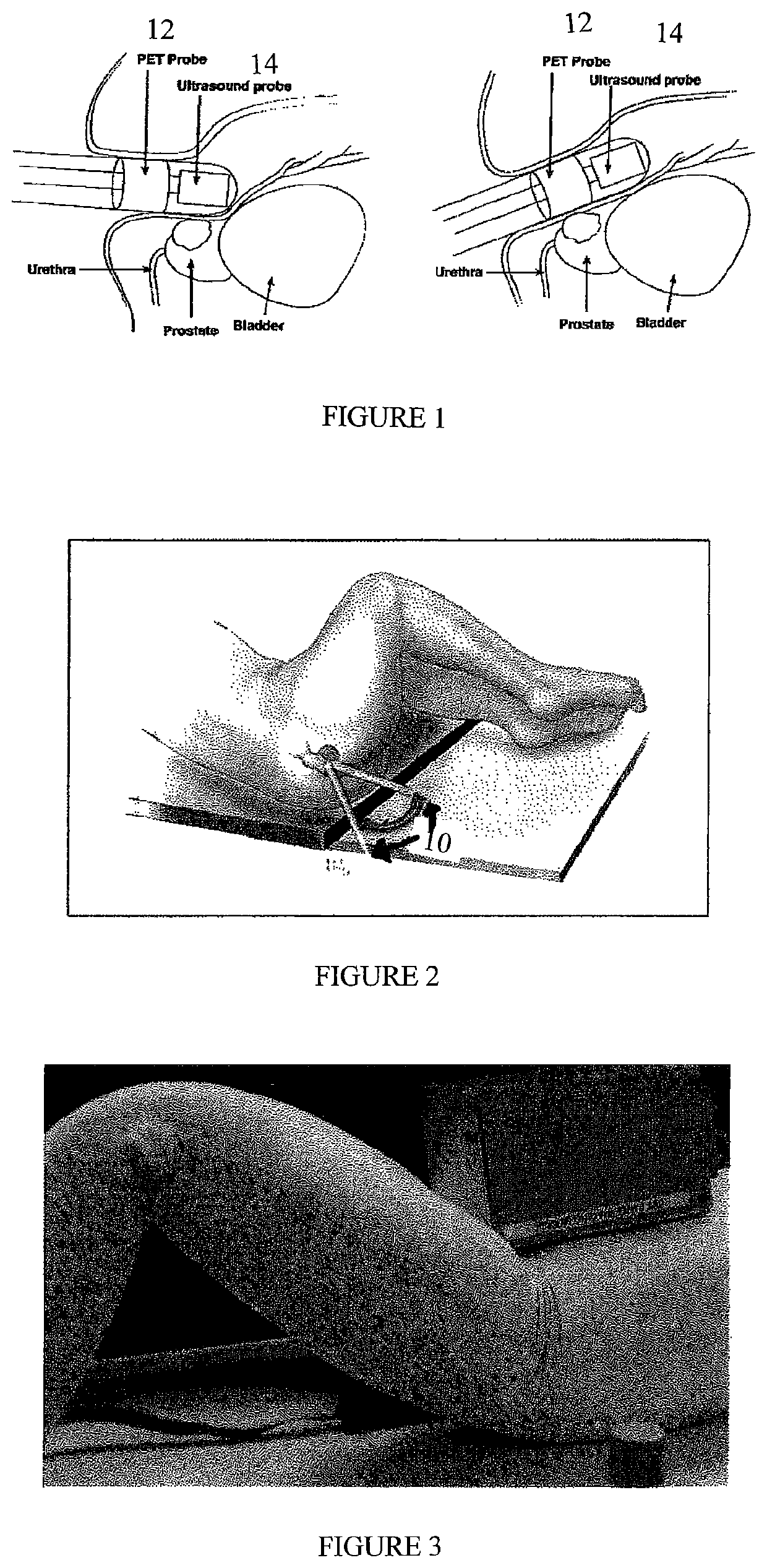 Endorectal prostate probe with combined PET and US modalities