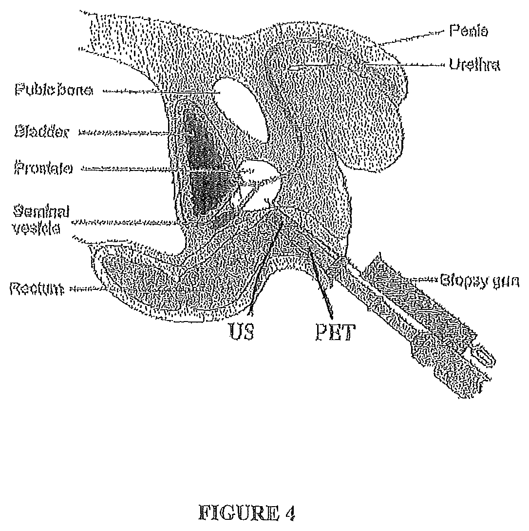 Endorectal prostate probe with combined PET and US modalities