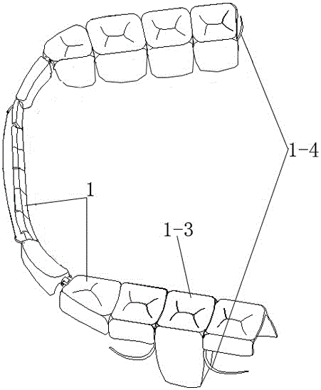 Track-chain type removable denture